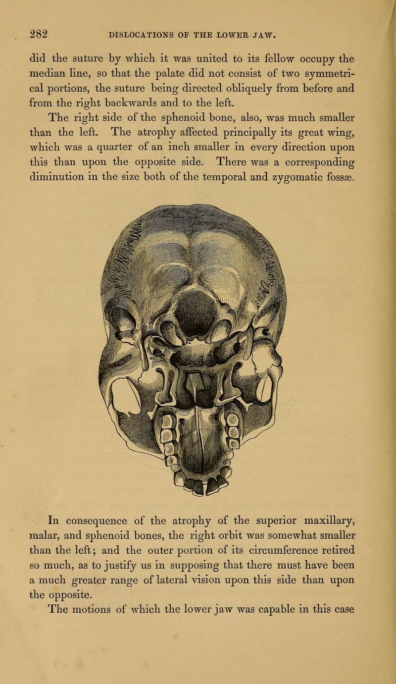 did the suture by which it was united to its fellow occupy the median line, so that the palate did not consist of two symmetri- cal portions, the suture being directed obliquely from before and from the right backwards and to the left. The right side of the sphenoid bone, also, was much smaller than the left. The atrophy affected principally its great wing, which was a quarter of an inch smaller in every direction upon this than upon the opposite side. There was a corresponding diminution in the size both of the temporal and zygomatic fossae. In consequence of the atrophy of the superior maxillary, malar, and sphenoid bones, the right orbit was somewhat smaller than the left; and the outer portion of its circumference retired so mnch, as to justify us in supposing that there must have been a much greater range of lateral vision upon this side than upon the opposite. The motions of which the lower jaw was capable in this case