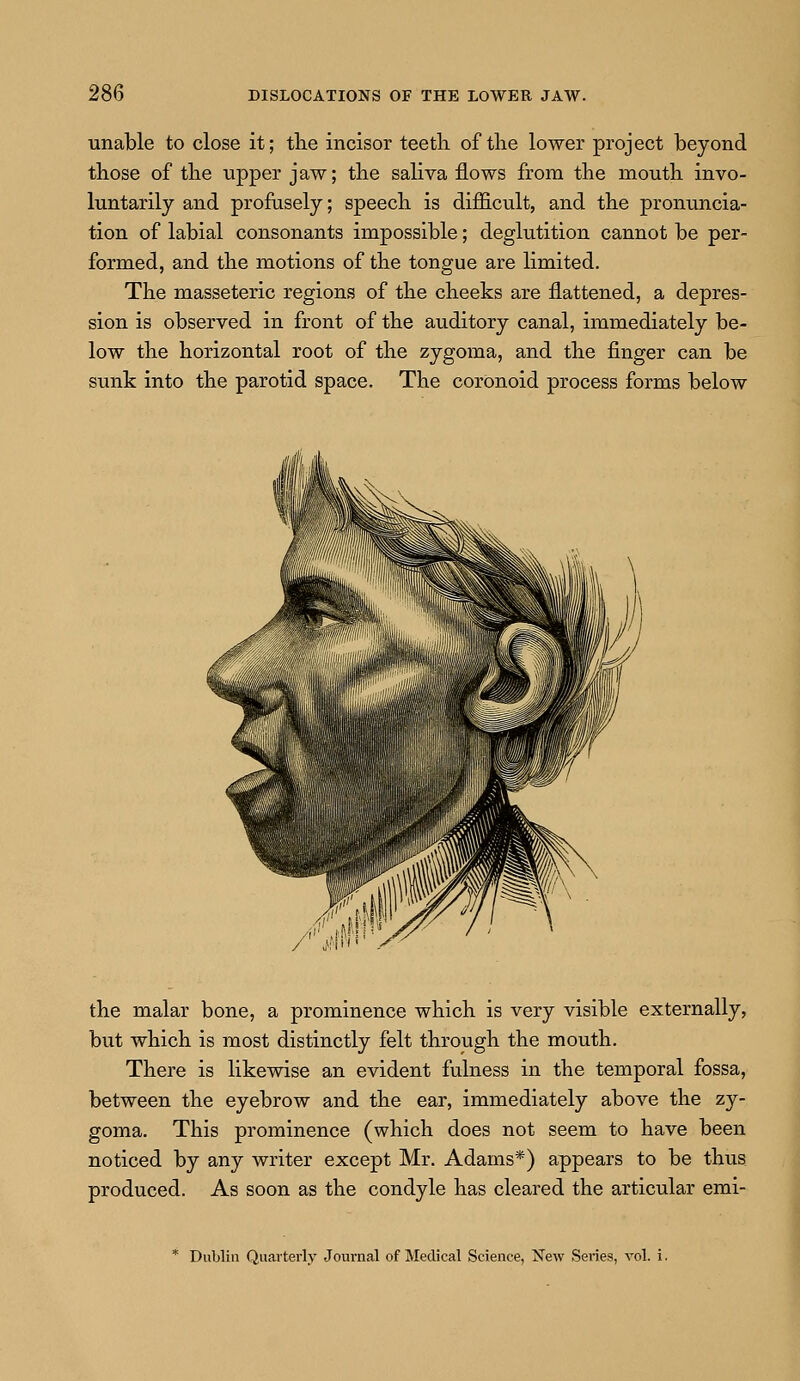 unable to close it; the incisor teetli of the lower project beyond those of the upper jaw; the saliva flows from the mouth invo- luntarily and profusely; speech is difficult, and the pronuncia- tion of labial consonants impossible; deglutition cannot be per- formed, and the motions of the tongue are limited. The masseteric regions of the cheeks are flattened, a depres- sion is observed in front of the auditory canal, immediately be- low the horizontal root of the zygoma, and the finger can be sunk into the parotid space. The coronoid process forms below the malar bone, a prominence which is very visible externally, but which is most distinctly felt through the mouth. There is likewise an evident fulness in the temporal fossa, between the eyebrow and the ear, immediately above the zy- goma. This prominence (which does not seem to have been noticed by any writer except Mr. Adams*) appears to be thus produced. As soon as the condyle has cleared the articular emi- Dublin Quarterly Journal of Medical Science, New Series, vol. i.