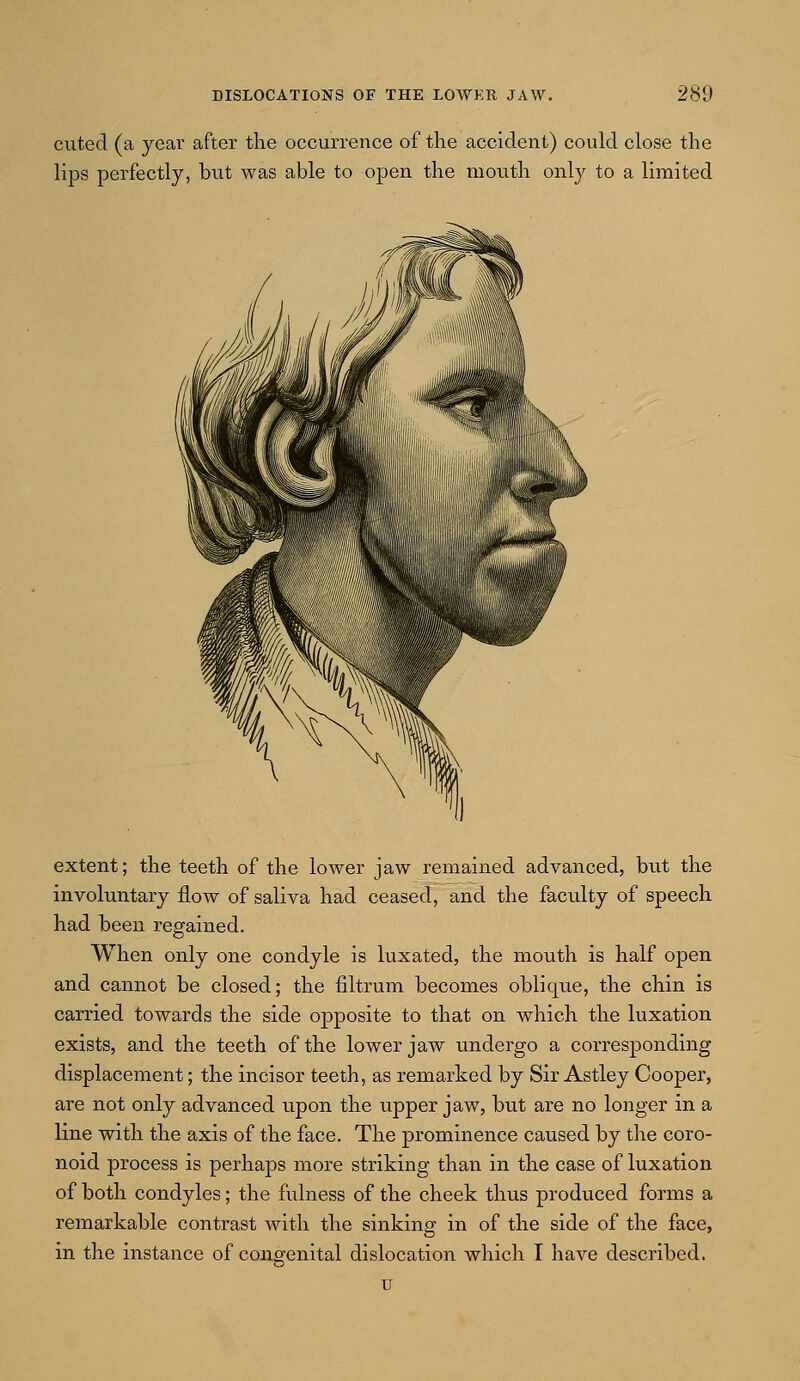 cuted (a year after the occurrence of the accident) could close the lips perfectly, but was able to open the mouth only to a limited extent; the teeth of the lower jaw remained advanced, but the involuntary flow of saliva had ceased, and the faculty of speech had been regained. When only one condyle is luxated, the mouth is half open and cannot be closed; the flltrum becomes oblique, the chin is carried towards the side opposite to that on which the luxation exists, and the teeth of the lower jaw undergo a corresponding displacement; the incisor teeth, as remarked by Sir Astley Cooper, are not only advanced upon the upper jaw, but are no longer in a line with the axis of the face. The prominence caused by the coro- noid process is perhaps more striking than in the case of luxation of both condyles; the fulness of the cheek thus produced forms a remarkable contrast with the sinking in of the side of the face, in the instance of congenital dislocation which I have described.