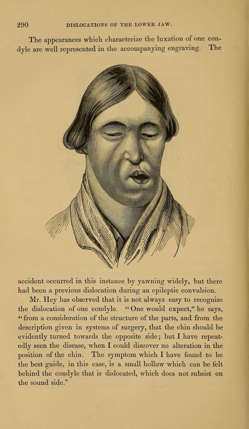 The appearances which characterize the luxation of one con- dyle are well represented in the accompanying engraving. The accident occurred in this instance by yawning widely, but there had been a previous dislocation during an epileptic convulsion. Mr. Hey has observed that it is not always easy to recognise the dislocation of one condyle.  One would expect, he says,  from a consideration of the structure of the parts, and from the description given in systems of surgery, that the chin should be evidently turned towards the opposite side; but I have repeat- edly seen the disease, when I could discover no alteration in the position of the chin. The symptom which I have found to be the best guide, in this case, is a small hollow which can be felt behind the condyle that is dislocated, which does not subsist on the sound side.