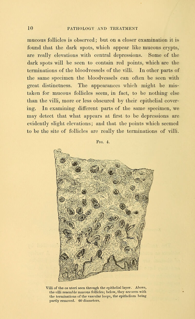 mucous follicles is observed; but on a closer examination it is found that the dark spots, which appear like mucous crypts, are really elevations with central depressions. Some of the dark spots will be seen to contain red points, which are the terminations of the bloodvessels of the villi. In other parts of the same specimen the bloodvessels can often be seen with great distinctness. The appearances which might be mis- taken for mucous follicles seem, in fact, to be nothing else than the villi, more or less obscured by their epithelial cover- ing. In examining different parts of the same specimen, we may detect that what appears at first to be depressions are evidently slight elevations; and that the points which seemed to be the site of follicles are really the terminations of villi. Fig. 4. Villi of the os uteri seen through the epithelial layer. Above, the villi resemble mucous follicles; below, they are seen with the terminations of the vascular loops, the epithelium being partly removed. 60 diameters.