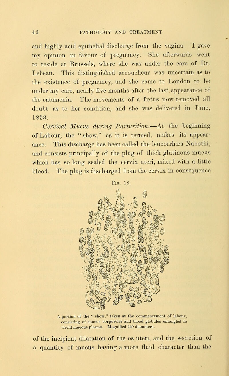 and highly acid epithelial discharge from the vagina. I gave my opinion in favour of pregnancy. She afterwards went to reside at Brussels, where she was under the care of Dr. Leheau. This distinguished accoucheur was uncertain as to the existence of pregnancy, and she came to London to he under my care, nearly five months after the last appearance of the catamenia. The movements of a foetus now removed all doubt as to her condition, and she was delivered in June, 1853. Cervical Mucus during Parturition.—At the beginning of Labour, the show, as it is termed, makes its appear- ance. This discharge has been called the leucorrhoea Nabothi, and consists principally of the plug of thick glutinous mucus which has so long sealed the cervix uteri, mixed with a little blood. The plug is discharged from the cervix in consequence Fig. 18. A portion of the  show, taken at the commencement of labour, consisting of mucus corpuscles and blood globules entangled in viscid mucous plasma. Magnified 240 diameters. of the incipient dilatation of the os uteri, and the secretion of a quantity of mucus having a more fluid character than the