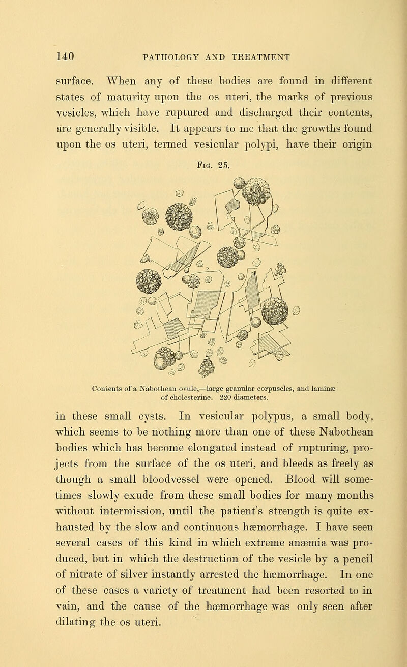 surface. When any of these bodies are found in different states of maturity upon the os uteri, the marks of previous vesicles, which have ruptured and discharged their contents, are generally visible. It appears to me that the growths found upon the os uteri, termed vesicular polypi, have their origin Fro. 25. Contents of a Nabothean ovule,—large granular corpuscles, and laminse of cholesterine. 220 diameters. in these small cysts. In vesicular polypus, a small body, which seems to be nothing more than one of these Nabothean bodies which has become elongated instead of rupturing, pro- jects from the surface of the os uteri, and bleeds as freely as though a small bloodvessel were opened. Blood will some- times slowly exude from these small bodies for many months without intermission, until the patient's strength is quite ex- hausted by the slow and continuous haemorrhage. I have seen several cases of this kind in which extreme anaemia was pro- duced, but in which the destruction of the vesicle by a pencil of nitrate of silver instantly arrested the haemorrhage. In one of these cases a variety of treatment had been resorted to in vain, and the cause of the haemorrhage was only seen after dilating the os uteri.