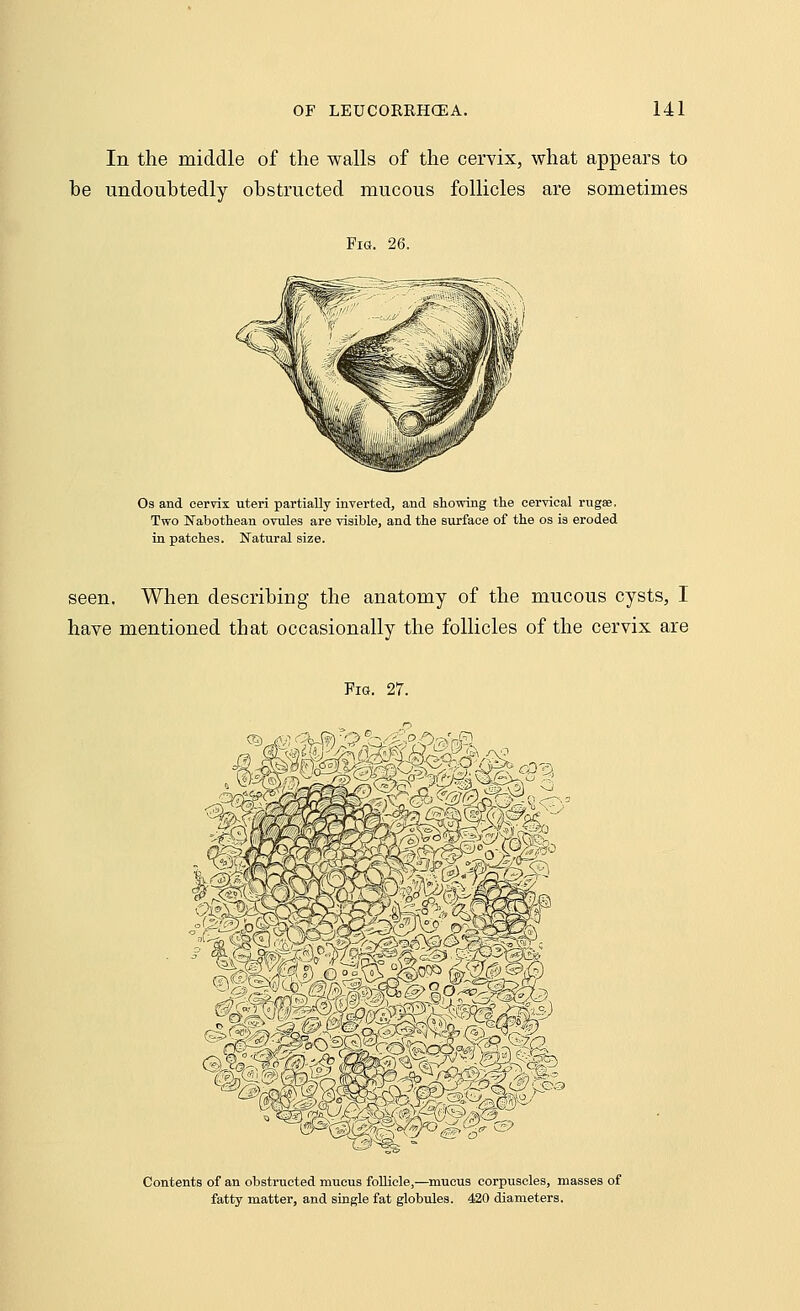 In the middle of the walls of the cervix, what appears to be undoubtedly obstructed mucous follicles are sometimes Fig. 26. Os and cervix uteri partially inverted, and showing the cervical rugae. Two Nabothean ovules are visible, and the surface of the os is eroded in patches. Natural size. seen. When describing the anatomy of the mucous cysts, I have mentioned that occasionally the follicles of the cervix are Fig. 27. Contents of an obstructed mucus follicle,—mucus corpuscles, masses of fatty matter, and single fat globules. 420 diameters.