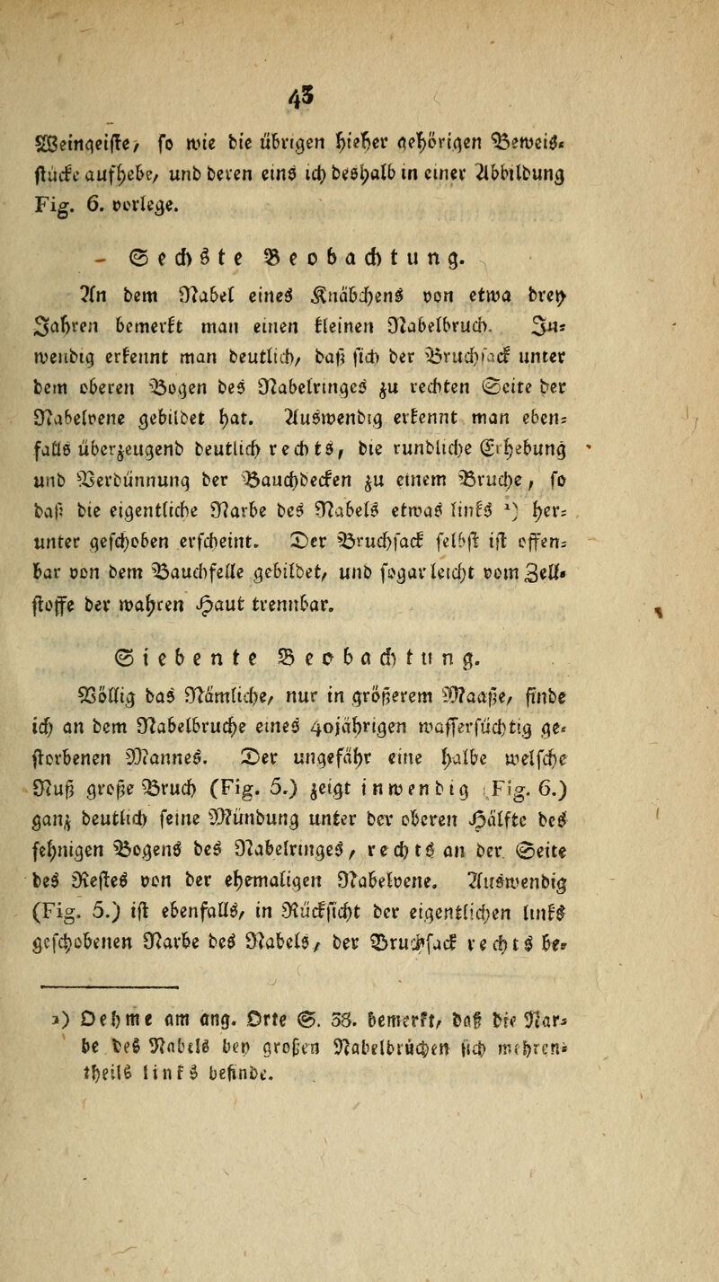 45 Sßeitiqelfle/ fo ivie bte übn^en ^ii'hiv (^e^ör^cn ^ewei^« fladc auf^e&e/ unb beven cinä ict) bes^alb in cmev 2lbbUbun^ Fig. 6. ocvkge. - (Sechste Beobachtung. ?{n bem 9?a&e( eine^ ^aä&d[)en^ tJon etwa bvet> Sa()ren bemevft man einen kleinen OfZabelbvuch. 3«? tveiibig ernennt man beutlirf)/ ba^ \iä^ ber ibruc^iacf unter bem oberen ^o(^en bes O^abetnnqeö ^u rechten ^ciu ber 9?abe{t>ene cjebilbet l)at. ^(uöwenbi,^ ernennt man eben? fatlö über^cugenb beutltc^ rechts, bie runblid)e ^rljebun^ unb 'Jöerbiinnunq ber \6auc{)be(fen ^u einem ^rucJ)e; fö ^aii bie eigentliche 9f?arbe be^ ?)?abeB itxv<i^ twU ^) ^er; unter (^ifä)obsn erfcheint. ^cr ^rud)fac! fe(b|t ifl cffen= Bar oon bem ^auchfede Q^hil'o^tf unb fo^ai'leicf)t ^omBeU* flüffe bev waf^ren ^aut trennbar. © t e b e n t e Sd c c 6 ö 6 t u n g. 5St>(% ba5 9^am(tche/ nur tn .^röf^erem ^-O^aaile, ftnbe id) an bem ^aheibvud)? eines 4oiab**igen u^afferfüchtig cje^ fVcrbenen 93(anne^. 5)er ungefab^ eine fyaibc \XHl{d)e 9^uf3 greife ^^rucb (Fig. 5.) ^eigt t «wen big F?g. 6.) QaiVff beutdch fetne tÜ^ürnbung unter ber oberen Spliiftc bc^ fe{;nigen ^ogenö beö Dlabelringe^ z red)t^ an ber, (8ette be^ Diej^eö oon ber ebematiqcn 9?abebene. Tfuöti^enbig (Fig. 5.) ifl ebenfaüö/ in S^ucfftcbt ber iic^^ntüdjin UnU öcfct)o&enen O^arbe beö dUUi^/ ber ^rudt'facf rechte hu j) Debme am öng. Drte (B. 38. bemerftA bot WTiat:^ be te§ 5^<ilulö l)q) oroj;en 9latdbiuc|)eii fj^) nuljrcni tbeilö linf^ befinbe.