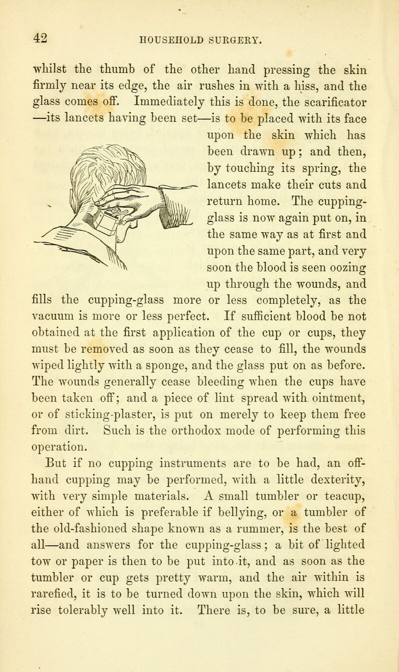 whilst the thumb of the other hand pressing the skin firmly near its edge, the air rushes in with a hiss, and the glass comes off. Immediately this is done, the scarificator —its lancets having been set—is to be placed with its face upon the skin which has been drawn up; and then, by touching its spring, the lancets make their cuts and return home. The cupping- glass is now again put on, in the same way as at first and upon the same part, and very soon the blood is seen oozing up through the wounds, and fills the cupping-glass more or less completely, as the vacuum is more or less perfect. If sufficient blood be not obtained at the first application of the cup or cups, they must be removed as soon as they cease to fill, the wounds wiped lightly with a sponge, and the glass put on as before. The wounds generally cease bleeding when the cups have been taken off; and a piece of lint spread with ointment, or of sticking-plaster, is put on merely to keep them free from dirt. Such is the orthodox mode of performing this operation. But if no cupping instruments are to be had, an off- hand cupping may be performed, with a little dexterity, with very simple materials. A small tumbler or teacup, either of which is preferable if bellying, or a tumbler of the old-fashioned shape known as a rummer, is the best of all—and answers for the cupping-glass; a bit of lighted tow or paper is then to be put into.it, and as soon as the tumbler or cup gets pretty warm, and the air within is rarefied, it is to be turned down upon the skin, which will rise tolerably well into it. There is, to be sure, a little