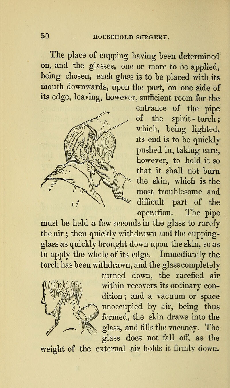 The place of cupping having been determined on, and the glasses, one or more to be applied, being chosen, each glass is to be placed with its mouth downwards, upon the part, on one side of its edge, leaving, however, sufficient room for the entrance of the pipe of the spirit - torch; which, being lighted, its end is to be quickly pushed in, taking care, however, to hold it so that it shall not burn the skin, which is the most troublesome and difficult part of the operation. The pipe must be held a few seconds in the glass to rarefy the air; then quickly withdrawn and the cupping- glass as quickly brought down upon the skin, so as to apply the whole of its edge. Immediately the torch has been withdrawn, and the glass completely turned down, the rarefied air within recovers its ordinary con- dition; and a vacuum or space unoccupied by air, being thus formed, the skin draws into the glass, and fills the vacancy. The glass does not fall off, as the weight of the external air holds it firmly down.