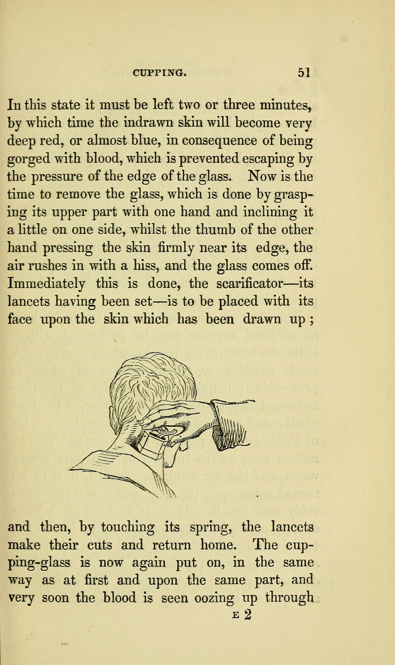 In this state it must be left two or three minutes, by which time the indrawn skin will become very deep red, or almost blue, in consequence of being gorged with blood, which is prevented escaping by the pressure of the edge of the glass. Now is the time to remove the glass, which is done by grasp- ing its upper part with one hand and inclining it a little on one side, whilst the thumb of the other hand pressing the skin firmly near its edge, the air rushes in with a hiss, and the glass comes off. Immediately this is done, the scarificator—its lancets having been set—is to be placed with its face upon the skin which has been drawn up; and then, by touching its spring, the lancets make their cuts and return home. The cup- ping-glass is now again put on, in the same way as at first and upon the same part, and very soon the blood is seen oozing up through e 2