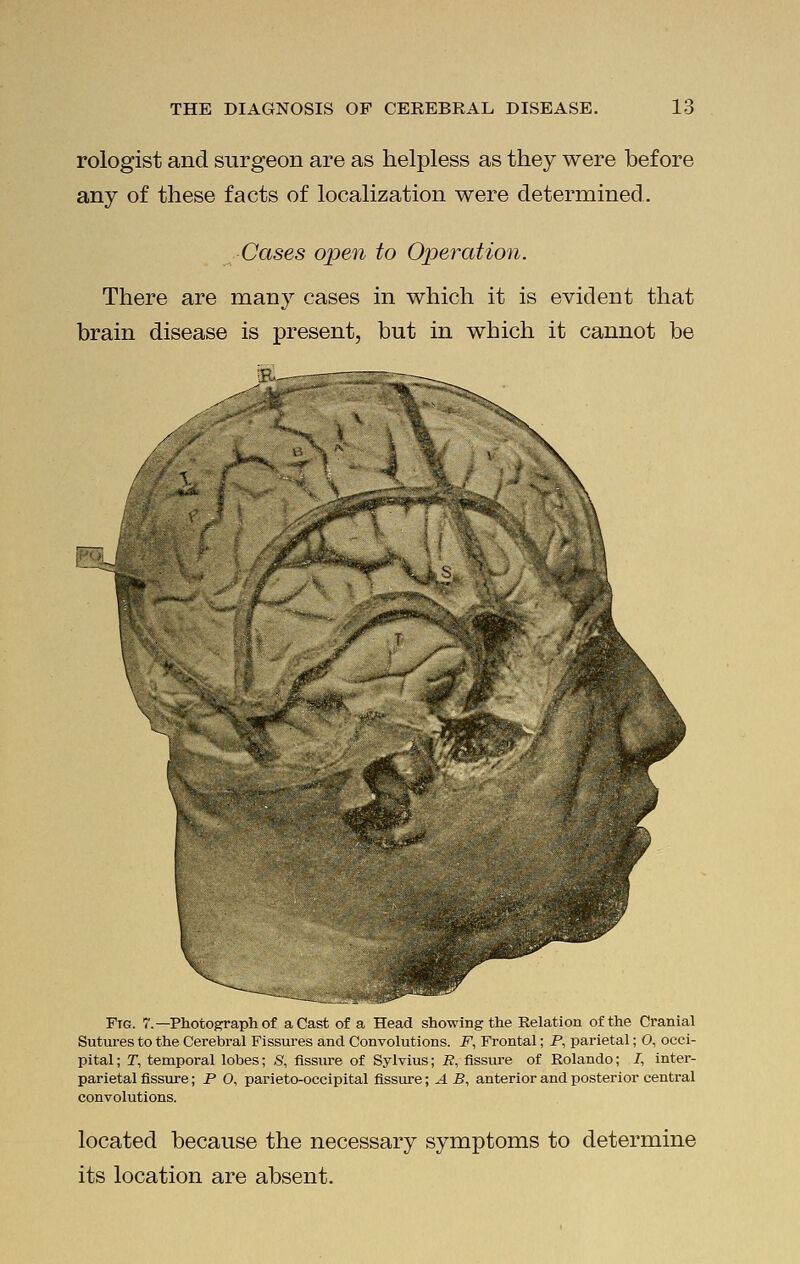 rologist and surgeon are as helpless as they were before any of these facts of localization were determined. Cases open to Operation. There are many cases in which it is evident that brain disease is present, but in which it cannot be rV Fig. 7.—Photograph of a Cast of a Head showing the Relation of the Cranial Sutures to the Cerebral Fissures and Convolutions. F, Frontal; P, parietal; O, occi- pital ; T, temporal lobes; S, fissxire of Sylvius; R, Assure of Rolando; I, inter- parietal fissure; P O, parietooccipital fissure; A B, anterior and posterior central convolutions. located because the necessary symptoms to determine its location are absent.
