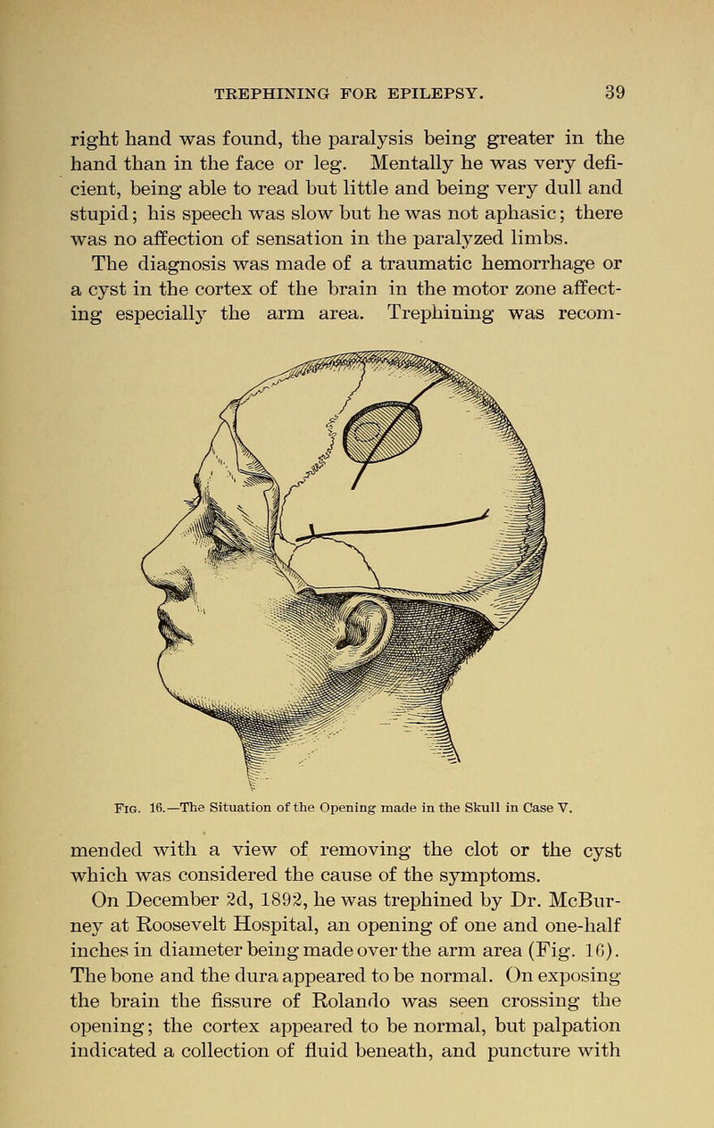 right hand was found, the paralysis being greater in the hand than in the face or leg. Mentally he was very defi- cient, being able to read but little and being very dull and stupid; his speech was slow but he was not aphasic; there was no affection of sensation in the paralyzed limbs. The diagnosis was made of a traumatic hemorrhage or a cyst in the cortex of the brain in the motor zone affect- ing especially the arm area. Trephining was recom- Fig. 16.—The Situation of the Opening made in the Skull in Case V. mended with a view of removing the clot or the cyst which was considered the cause of the symptoms. On December 2d, 1892, he was trephined by Dr. McBur- ney at Roosevelt Hospital, an opening of one and one-half inches in diameter being made over the arm area (Fig. 1G). The bone and the dura appeared to be normal. On exposing the brain the fissure of Rolando was seen crossing the opening; the cortex appeared to be normal, but palpation indicated a collection of fluid beneath, and puncture with