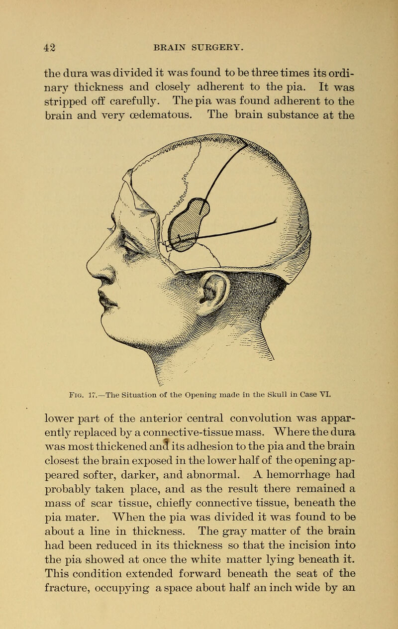 the dura was divided it was found to be three times its ordi- nary thickness and closely adherent to the pia. It was stripped off carefully. The pia was found adherent to the brain and very cedematous. The brain substance at the Fig. 17.—The Situation of the Opening made in the Skull in Case VI. lower part of the anterior central convolution was appar- ently replaced by a connective-tissue mass. Where the dura was most thickened ana its adhesion to the pia and the brain closest the brain exposed in the lower half of the opening ap- peared softer, darker, and abnormal. A hemorrhage had probably taken place, and as the result there remained a mass of scar tissue, chiefly connective tissue, beneath the pia mater. When the pia was divided it was found to be about a line in thickness. The gray matter of the brain had been reduced in its thickness so that the incision into the pia showed at once the white matter lying beneath it. This condition extended forward beneath the seat of the fracture, occupying a space about half an inch wide by an