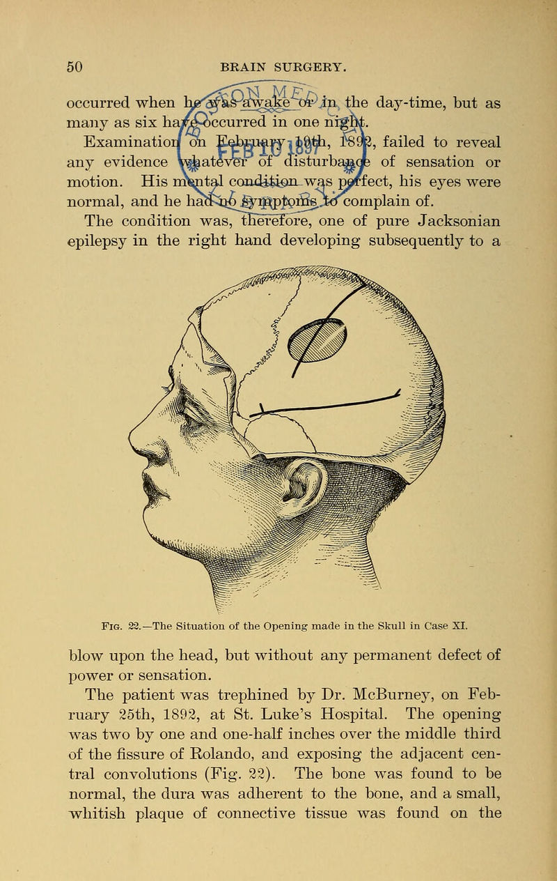 occurred when many as six ha Examination o: any evidence What motion. His m normal, and he ha! ake oPjn the day-time, but as ccurred in one hi^ tawii^tia, f8^3, failed to reveal r of disturbajade of sensation or onditioJi-was perfect, his eyes were ^r^loiSsjkJcomplain of. The condition was, therefore, one of pure Jacksonian epilepsy in the right hand developing subsequently to a Fig. 22.—The Situation of the Opening made in the Skull in Case XI. blow upon the head, but without any permanent defect of power or sensation. The patient was trephined by Dr. McBurney, on Feb- ruary 25th, 1892, at St. Luke's Hospital. The opening was two by one and one-half inches over the middle third of the fissure of Rolando, and exposing the adjacent cen- tral convolutions (Fig. 22). The bone was found to be normal, the dura was adherent to the bone, and a small, whitish plaque of connective tissue was found on the