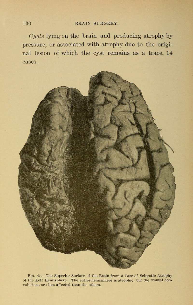Cysts lying on the brain and producing atrophy by pressure, or associated with atrophy due to the origi- nal lesion of which the cyst remains as a trace, 14 cases. Fig. 41.—The Superior Surface of the Brain from a Case of Sclerotic Atrophy of the Left Hemisphere. The entire hemisphere is atrophic, but the frontal con- volutions are less affected than the others.