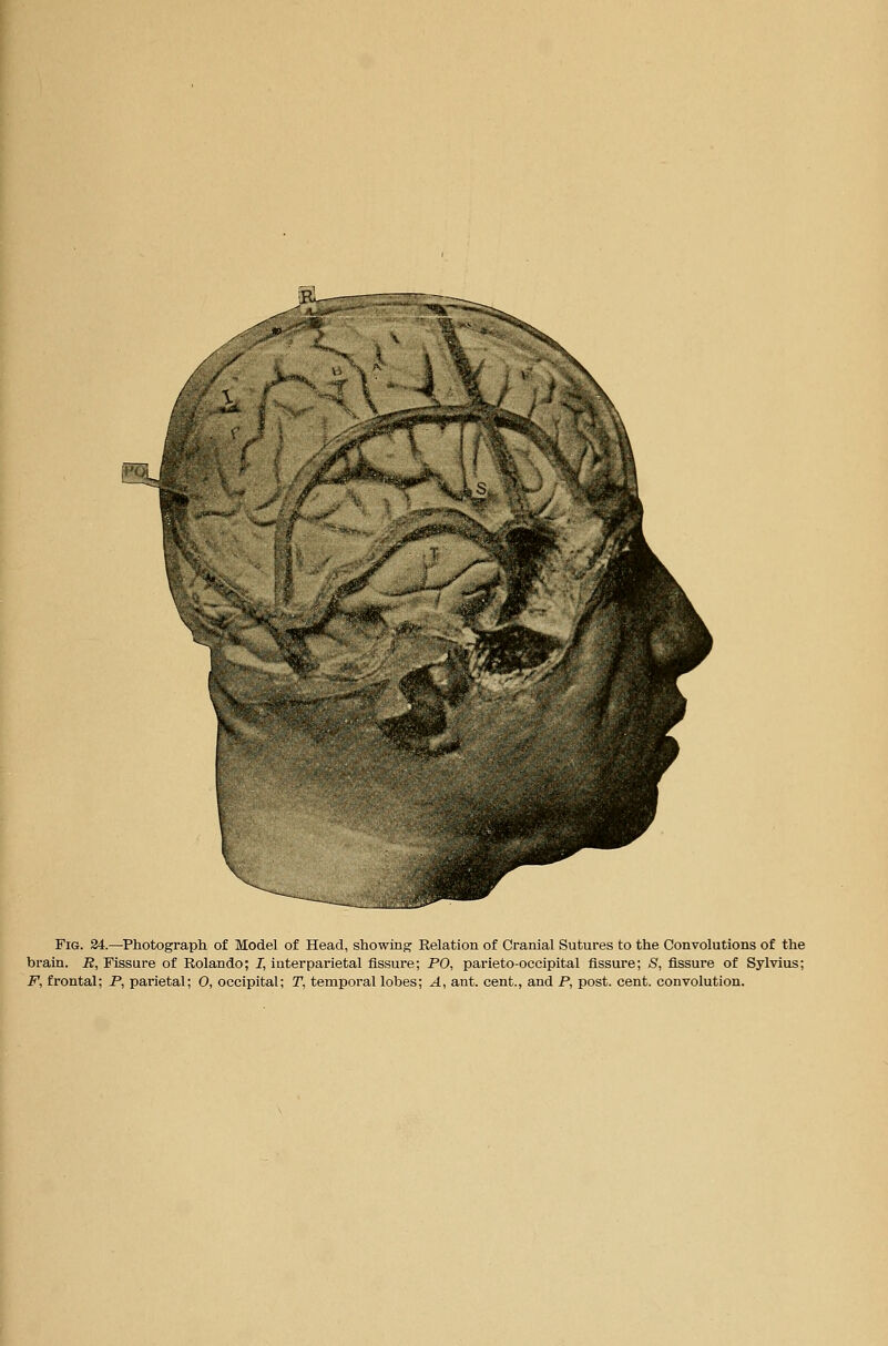 Fig. 24.—Photograph of Model of Head, showing Relation of Cranial Sutures to the Convolutions of the brain. R, Fissure of Rolando; I, interparietal fissure; PO, parietooccipital fissure; S, fissure of Sylvius; F, frontal; P, parietal; O, occipital; T, temporal lobes; A, ant. cent., and P, post. cent, convolution.