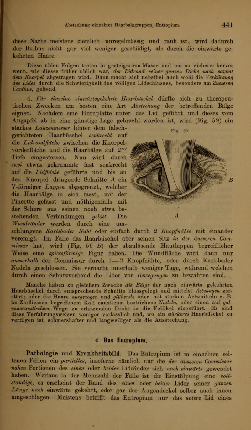 Fig. 59. diese Narbe meistens ziemlich unregelmässig und rauh ist, wird dadurch der Bulbus nicht gar viel weniger geschädigt, als durch die einwärts ge- kehrten Haare. Diese üblen Folgen treten in gesteigertem Masse und um so sicherer hervor wenn, wie dieses früher üblich war, der Lidrand seiner ganzen Dicke nach sammt dem Knorpel abgetragen wird. Dann macht sich nebstbei auch wohl die Verkürzung des Lides durch die Schwierigkeit des völligen Lidschlusses, besonders am äusseren Canthus, geltend. 4. Für einzelne einwärtsgekehrte Haarbüschel dürfte sich zu therapeu- tischen Zwecken am besten eine Art Abstechung der betreffenden Bälge eignen. Nachdem eine Hornplatte unter das Lid geführt und dieses vom Augapfel ab in eine günstige Lage gebracht worden ist, wird (Fig. 59) ein starkes Lanzenmesser hinter dem falsch- gerichteten Haarbüschel senkrecht auf die Lidrandfläche zwischen die Knorpel- vorderfläche und die Haarbälge auf 2' Tiefe eingestossen. Nun wird durch zwei etwas gekrümmte fast senkrecht auf die Lidfläche geführte und bis an den Knorpel dringende Schnitte A ein C V-förmiger Lappen abgegrenzt, welcher die Haarbälge in sich fasst, mit der Pincette gefasst und nöthigenfalls mit der Schere aus seinen noch etwa be- stehenden Verbindungen gelöst. Die A Wundränder werden durch eine um- schlungene Karlsbader Naht oder einfach durch 2 Knopfnähte mit einander vereinigt. Im Falle das Haarbüschel aber seinen Sitz in der äusseren Com- missur hat, wird (Fig. 59 B) der abzulösende Hautlappen begreiflicher Weise eine spiessförmige Figur haben. Die Wundfläche wird dann nur ausserhalb der Commissur durch 1—2 Knopfnähte, oder durch Karlsbader Nadeln geschlossen. Sie vernarbt innerhalb weniger Tage, während welchen durch einen Schutzverband die Lider vor Bewegungen zu bewahren sind. Manche haben zu gleichem Zwecke die Bälge der nach einwärts gekehrten Haarbüschel durch entsprechende Schnitte blossgelegt und mittelst Aetzungen zer- stört; oder die Haare ausgezogen und glühende oder mit starken Aetzrnitteln z. B. im Zerfliessen begriffenem Kali causticum bestrichene Nadeln, oder einen auf gal- vanocau^tischem Wege zu erhitzenden Draht in die Follikel eingeführt. Es sind diese Verfahrungsweisen weniger verlässlich und, wo ein stärkeres Haarbüschel zu vertilgen ist, schmerzhafter und langweiliger als die Ausstechung. m b 4. Das Entropium. Pathologie und Krankheitsbild. Das Entropium ist in einzelnen sel- tenen Fällen ein partielles, insoferne nämlich nur die der äusseren Commissur nahen Portionen des einen oder beider Lidränder sich nach einwärts gewendet haben. Weitaus in der Mehrzahl der Fälle ist die Einstülpung eine voll- ständige, es erscheint der Rand des einen oder beider Lider seiner ganzen Länge nach einwärts gekehrt, oder gar der Augendeckel selber nach innen umgeschlagen. Meistens betrifft das Entropium nur das untere Lid eines