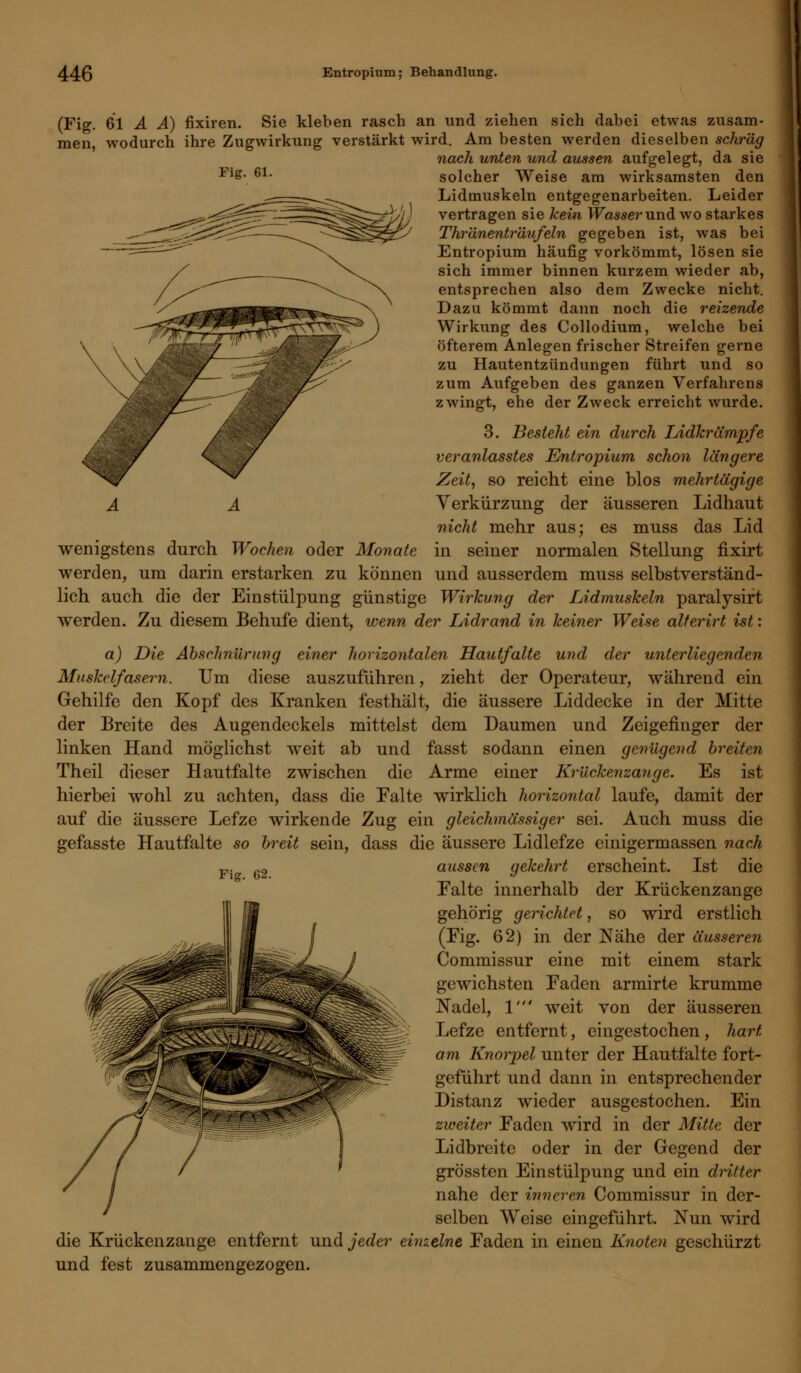 Fig. 61. (Fig. 61 A A) fixiren. Sie kleben rasch an und ziehen sich dabei etwas zusam- men, wodurch ihre Zugwirkung verstärkt wird. Am besten werden dieselben schräg nach unten und aussen aufgelegt, da sie solcher Weise am wirksamsten den Lidmuskeln entgegenarbeiten. Leider vertragen sie kein Wasser und. wo starkes Thränentr'dufeln gegeben ist, was bei Entropium häufig vorkömmt, lösen sie sich immer binnen kurzem wieder ab, entsprechen also dem Zwecke nicht. Dazu kömmt dann noch die reizende Wirkung des Collodium, welche bei öfterem Anlegen frischer Streifen gerne zu Hautentzündungen führt und so zum Aufgeben des ganzen Verfahrens zwingt, ehe der Zweck erreicht wurde. 3. Besteht ein durch Lidkrämpfe veranlasstes Entropium schon längere Zeit, so reicht eine blos mehrtägige Verkürzung der äusseren Lidhaut nicht mehr aus; es muss das Lid wenigstens durch Wochen oder Monate in seiner normalen Stellung fixirt werden, um darin erstarken zu können und ausserdem muss selbstverständ- lich auch die der Einstülpung günstige Wirkung der Lidmuskeln paralysirt werden. Zu diesem Behufe dient, wenn der Lidrand in keiner Weise alterirt ist: a) Die Abschnürung einer horizontalen Hautfalte und der unterliegenden Muskelfasern. Um diese auszuführen, zieht der Operateur, während ein Gehilfe den Kopf des Kranken festhält, die äussere Liddecke in der Mitte der Breite des Augendeckels mittelst dem Daumen und Zeigefinger der linken Hand möglichst weit ab und fasst sodann einen genügend breiten Theil dieser Hautfalte zwischen die Arme einer Krückenzange. Es ist hierbei wohl zu achten, dass die Falte wirklich horizontal laufe, damit der auf die äussere Lefze wirkende Zug ein gleichmässiger sei. Auch muss die gefasste Hautfalte so breit sein, dass die äussere Lidlefze einigermassen nach Yw 62 aussen gekehrt erscheint. Ist die Falte innerhalb der Krückenzange gehörig gerichtet, so wird erstlich (Fig. 62) in der Nähe der äusseren Commissur eine mit einem stark gewichsten Faden armirte krumme Nadel, 1' weit von der äusseren Lefze entfernt, eingestochen , hart am Knorpel unter der Hautfaltc fort- geführt und dann in entsprechender Distanz wieder ausgestochen. Ein zweiter Faden wird in der Mitte der Lidbreite oder in der Gegend der grössten Einstülpung und ein dritter nahe der inneren Commissur in der- selben Weise eingeführt. Nun wird die Krückenzange entfernt und jeder einzelne Faden in einen Knoten geschürzt und fest zusammengezogen.