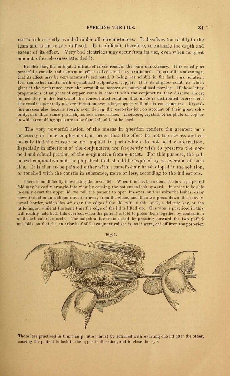 nse is to be strictly avoided under all circumstances. It dissolves too readily in the tears and is thus easily diffused. It is difficult, therefore, to estimate the depth and extent of its effect. Very bad cicatrices may occur from its use, even when no great amount of carelessness attended it. Besides this, the mitigated nitrate of silver renders the pure unnecessary. It is equally as powerful a caustic, and as great an effect as is desired may be attained. It has still an advantage, that its effect may be very accurately estimated, it being less soluble in the lachrymal solution. It is somewhat similar with crystallized sulphate of copper. It is its slighter solubility which gives it the preference over the crystalline masses or uncrystallized powder. If these latter preparations of sulphate of copper come in contact with the conjunctiva, they dissolve almost immediately in the tears, and the concentrated solution thus made is distributed everywhere. The result is generally a severe irritation over a large space, with all its consequences. Crystal- line masses also become rough, even during the cauterization, on account of their great solu- bility, and thus cause parenchymatous hemorrhage. Therefore, crystals of sulphate of copper in which crumbling spots are to be found should not be used. The very powerful action of the means in question renders the greatest care necessity in iheir employment, in order that the effect be not too severe, and es- pecially that the caustic be not applied to parts which do not need cauterization. Especially in affections of the conjunctiva, we frequently wish to preserve the cor- neal and scleral portion of the conjunctiva from contact. For this purpose, the pal- pebral conjunctiva and the palpebral fold should be exposed by an eversion of both lids. It is then to be painted either with a camel's-hair brush dipped in the solution, or touched with the caustic in substance, more or less, according to the indications. There is no difficulty in everting the lower lid. When this has been done, the lower palpebral fold may be easily brought into view by causing the patient to look upward. In order to be able to easily evert the upper lid, we tell the patient to open his eyes, and we seize the lashes, draw down the lid in an oblique direction away from the globe, and then we press down the convex tarsal border, which lies 4' over the edge of the lid, with a thin stick, a delicate key, or the little finger, while at the same time the edge of the lid is lifted up. One who is practiced in this will readily hold both lids everted, when the patient is told to press them together by contraction of the orbicularis muscle. The palpebral fissure is closed by pressing forward the two puffed- out folds, so that the anterior half of the conjunctival sac is, as it were, cut off from the posterior, Fig. 1. Those less practiced in this manip Vatioi must be satisfied with everting one lid after the other, causing the patient to look in the opposite direction, and to elase the eye.