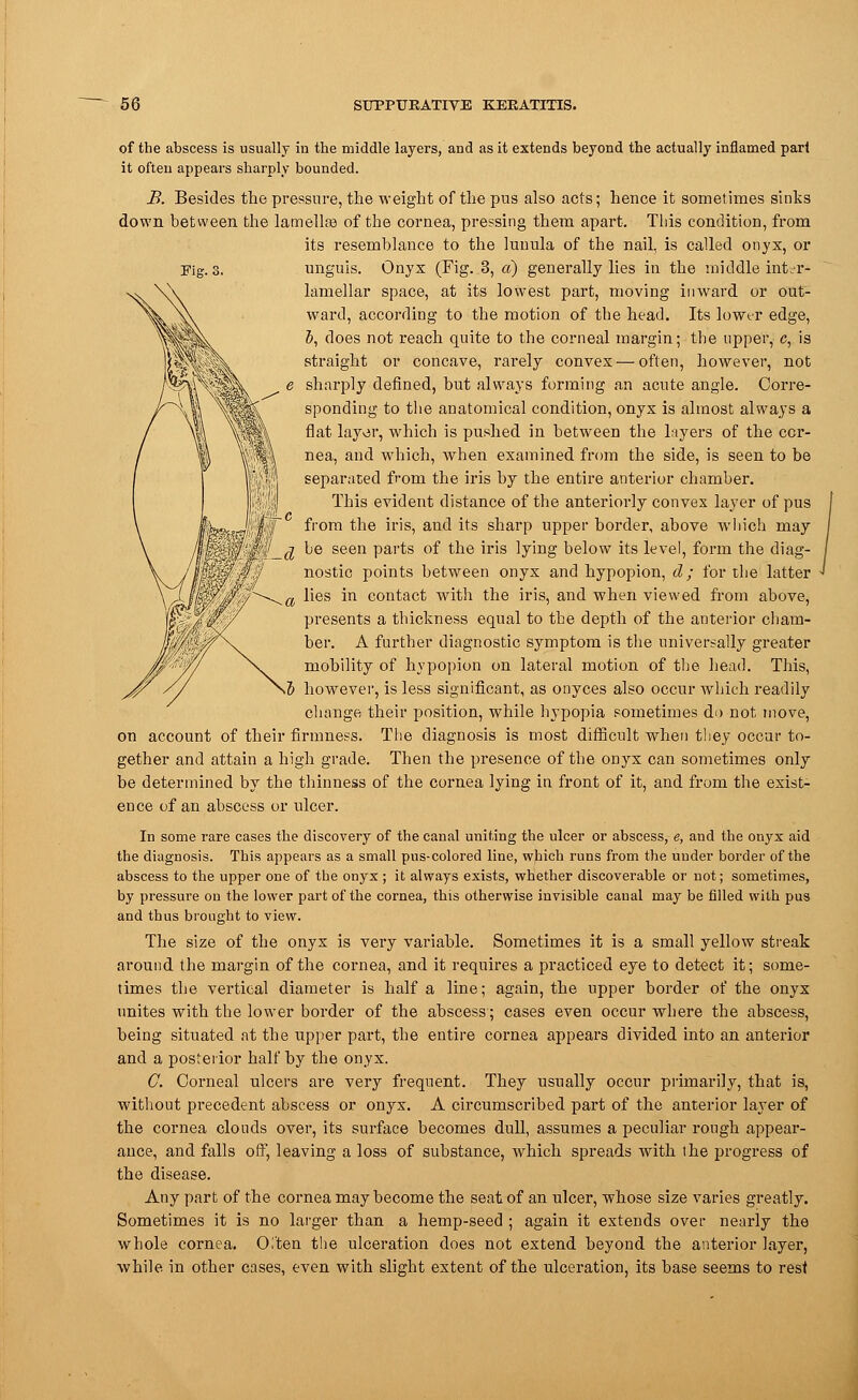 of the abscess is usually iu the middle layers, and as it extends beyond the actually inflamed pari it often appears sharply bounded. B. Besides the pressure, the weight of the pus also acts; hence it sometimes sinks down between the lamellae of the cornea, pressing them apart. This condition, from its resemblance to the lunula of the nail, is called onyx, or unguis. Onyx (Fig. 3, a) generally lies in the middle inter* lamellar space, at its lowest part, moving inward or out- ward, according to the motion of the head. Its lower edge, 5, does not reach quite to the corneal margin; the upper, c, is straight or concave, rarely convex — often, however, not sharply defined, but always forming an acute angle. Corre- sponding to the anatomical condition, onyx is almost always a flat layor, which is pushed in between the layers of the cor- nea, and which, when examined from the side, is seen to be separated from the iris by the entire anterior chamber. This evident distance of the anteriorly convex layer of pus from the iris, and its sharp upper border, above which may g be seen parts of the iris lying below its level, form the diag- nostic points between onyx and hypopion, d; for the latter lies in contact with the iris, and when viewed from above, presents a thickness equal to the depth of the anterior cham- ber. A further diagnostic symptom is the universally greater mobility of hypopion on lateral motion of the head. This, v5 however, is less significant, as onyces also occur which readily change their position, while hypopia sometimes do not move, on account of their firmness. The diagnosis is most difficult when they occur to- gether and attain a high grade. Then the presence of the onyx can sometimes only be determined by the thinness of the cornea lying in front of it, and from the exist- ence of an abscess or ulcer. In some rare cases the discovery of the canal uniting the ulcer or abscess, e, and the onyx aid the diagnosis. This appears as a small pus-colored line, which runs from the under border of the abscess to the upper one of the onyx ; it always exists, whether discoverable or not; sometimes, by pressure on the lower part of the cornea, this otherwise invisible canal may be filled with pus and thus brought to view. The size of the onyx is very variable. Sometimes it is a small yellow streak around the margin of the cornea, and it requires a practiced eye to detect it; some- times the vertical diameter is half a line; again, the upper border of the onyx unites with the lower border of the abscess; cases even occur where the abscess, being situated at the upper part, the entire cornea appears divided into an anterior and a posterior half by the onyx. C. Corneal ulcers are very frequent. They usually occur primarily, that is, without precedent abscess or onyx. A circumscribed part of the anterior layer of the cornea clouds over, its surface becomes dull, assumes a peculiar rough appear- ance, and falls off, leaving a loss of substance, which spreads with the progress of the disease. Any part of the cornea may become the seat of an ulcer, whose size varies greatly. Sometimes it is no larger than a hemp-seed ; again it extends over nearly the whole cornea. 0,'ten the ulceration does not extend beyond the anterior layer, while in other cases, even with slight extent of the ulceration, its base seems to rest