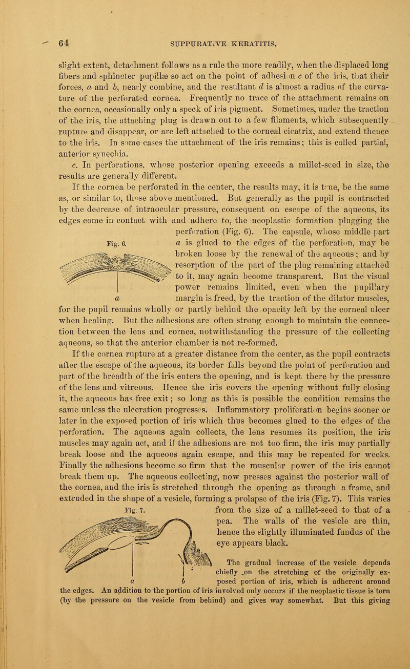 slight extent, detachment follows as a rule the more readily, when the displaced long fibers and sphincter pupilhe so act on the point of adhesim c of the iris, that their forces, a and b, nearly combine, and the resultant d is almost a radius of the curva- ture of the perforated cornea. Frequently no trace of the attachment remains on the cornea, occasionally only a speck of iris pigment. Sometimes, under the traction of the iris, the attaching plug is drawn out to a few filaments, which subsequently rupture and disappear, or are left attached to the corneal cicatrix, and extend thence to the iris. In s>me cases the attachment of the iris remains; this is called partial, anterior synechia. c. In perforations, whose posterior opening exceeds a millet-seed in size, the results are generally different. If the cornea be perforated in the center, the results may, it is tine, be the same as, or similar to, those above mentioned. But generally as the pupil is contracted by the decrease of intraocular pressure, consequent on escape of the aqueous, its edges come in contact with and adhere to, the neoplastic formation plugging the perforation (Fig. 6). The capsule, whose middle part 'ig. 6. a is glued to the edges of the perforation, may be broken loose by the renewal of the aqueous; and by  ^>. resorption of the part of the plug remaining attached ^ to it, may again become transparent. But the visual power remains limited, even when the pupillary a margin is freed, by the traction of the dilator muscles, for the pupil remains wholly or partly behind the opacity left by the corneal ulcer when healing. But the adhesions are often strong enough to maintain the connec- tion between the lens and cornea, notwithstanding the pressure of the collecting aqueous, so that the anterior chamber is not re-formed. If the cornea rupture at a greater distance from the center, as the pupil contracts after the escape of the aqueous, its border falls beyond the point of perforation and part of the breadth of the iris enters the opening, and is kept there by the pressure of the lens and vitreous. Hence the iris covers the opening without fully closing it, the aqueous has free exit; so long as this is possible the condition remains the same unless the ulceration progresses. Inflammatory proliferation begins sooner or later in the exposed portion of iris which thus becomes glued to the edges of the perforation. The aqueous again collects, the lens resumes its position, the iris muscles may again act, and if the adhesions are not too firm, the iris may partially break loose and the aqueous again escape, and this may be repeated for weeks. Finally the adhesions become so firm that the muscular power of the iris cannot break them up. The aqueous collecting, now presses against the posterior wall of the cornea, and the iris is stretched through the opening as through a frame, and extruded in the shape of a vesicle, forming a prolapse of the iris (Fig. 7). Tins varies Eig. 7. from the size of a millet-seed to that of a pea. The walls of the vesicle are thin, hence the slightly illuminated fundus of the eye appears black. The gradual increase of the vesicle depends chiefly .on the stretching of the originally ex- posed portion of iris, which is adherent around the edges. An addition to the portion of iris involved only occurs if the neoplastic tissue is torn (by the pressure on the vesicle from behiud) and gives way somewhat. But this giving