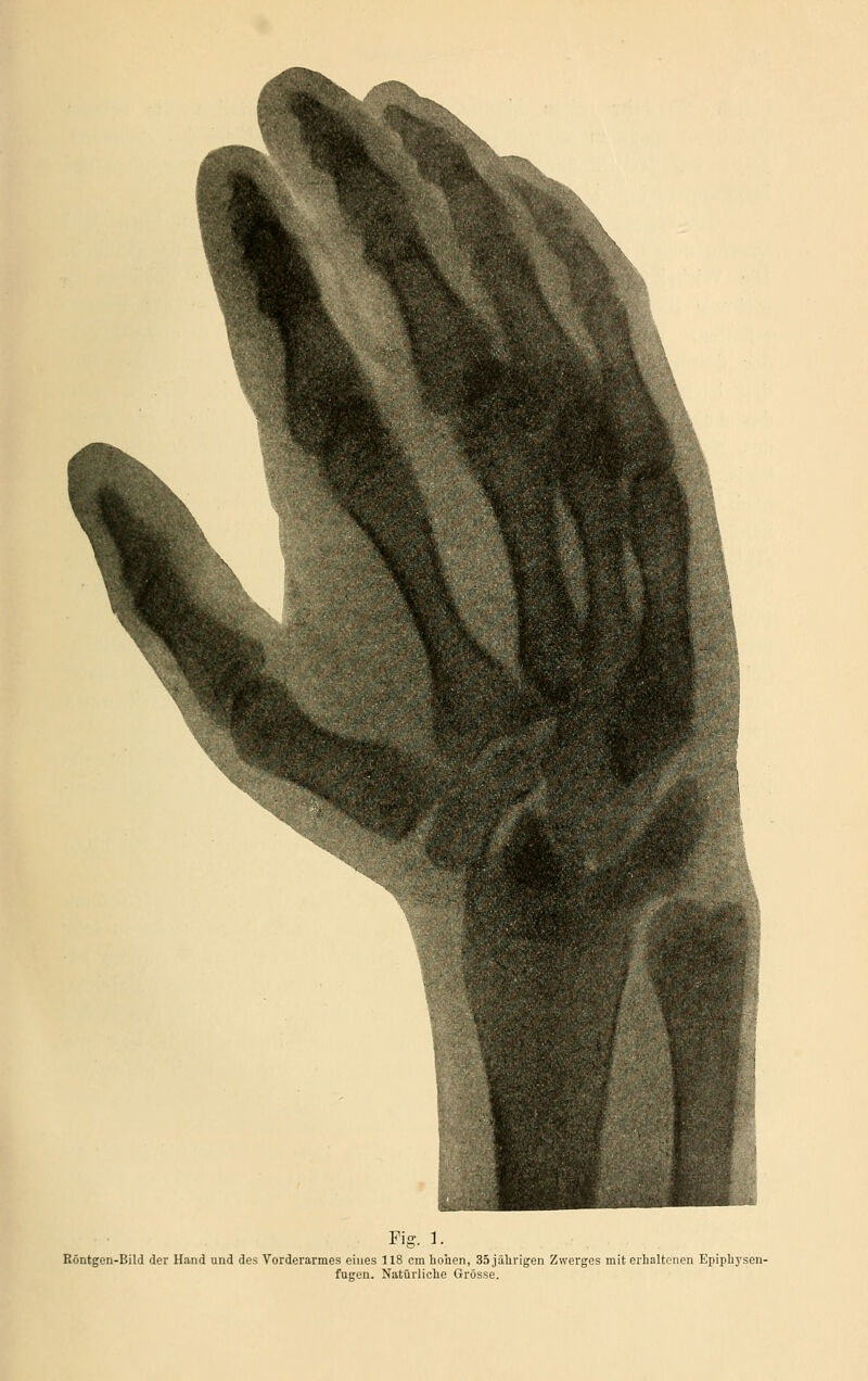 Fig. 1. Röntgen-Bild der Hand und des Vorderarmes eines 118 cm hohen, 35 jährigen Zwerges mit erhaltenen Epiphysen- fugen. Natürliche Grösse.