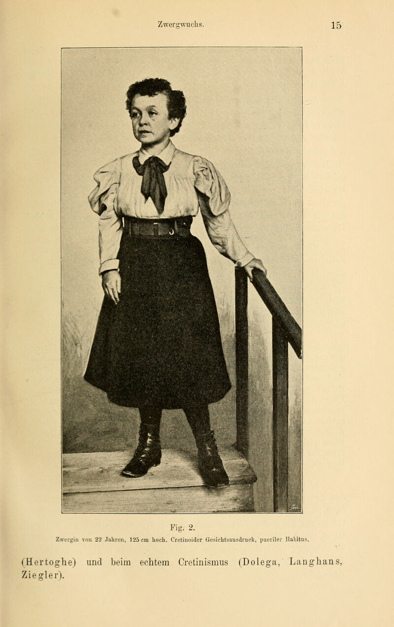 Fig. 2. Zwergin von 22 Jahren, 125 cm hoch. Cretinoider Gesichtsausdruck, pueriler Habitus. (Hertoghe) und beim echtem Cretinismus (Dolega, Langhans, Ziegler).