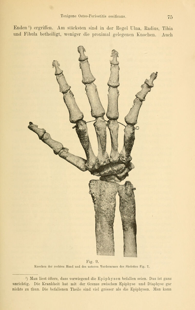 Enden ') ergriffen. Am stärksten sind in der Eegel Ulna, Eadius, Tibia und Fibula betheiligt, weniger die proximal gelegenen Knochen. Auch Fig. 9. Knochen der rechten Hand und des unteren Vorderarmes des Skelettes Fig. 7. ') Man liest öfters, class vorwiegend die Epiphysen befallen seien. Das ist ganz unrichtig. Die Krankheit hat mit der Grenze zwischen Epiphyse und Diaphyse gar nichts zu thun. Die befallenen Theile sind viel grösser als die Epiphysen. Man kann