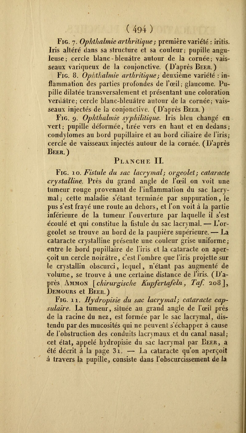 Fig. 7. Ophthalmie arthritique ; première variété : iritis. Iris altéré dans sa structure et sa couleur; pupille angu- leuse; cercle blanc-bleuâtre autour de la cornée; vais- seaux variqueux de la conjonctive. ( D'après Béer. ) Fig. 8. Ophthalmie arthritique ; deuxième variété : in- flammation des parties profondes de l'œil; glaucome. Pu- pille dilatée transversalement et présentant une coloration verûàlre; cercle blanc-bleuâtre autour de la cornée; vais- seaux injectés de la conjonctive. (D'après Béer.) Fig. 9. Ophthalmie sjphilitique. Iris bleu changé en vert ; pupille déformée, tirée vers en haut et en dedans ; condylomes au bord pupillaire et au bord ciliaire de l'iris; cercle de vaisseaux injectés autour de la cornée. (D'après Béer.) Planche IL Fig. 10. Fistule du sac lacrymal; orgeolet; cataracte crystalline. Près du grand angle de l'œil on voit une tumeur rouge provenant de l'inflammation du sac lacry- mal ; cette maladie s'étant terminée par suppuration, le pus s'est frayé une route au dehors, et l'on voit à la partie inférieure de la tumeur l'ouverture par laquelle il s'est écoulé et qui constitue la fistule du sac lacrymal. — L'or- geolet se trouve au bord de la paupière supérieure. — La cataracte crystalline présente une couleur grise uniforme ; entre le bord pupillaire de l'iris et la cataracte on aper- çoit un cercle noirâtre, c'est l'ombre que l'iris projette sur le crystallin obscurci, lequel, n'étant pas augmenté de volume, se trouve à une certaine distance de l'iris. (D'a- près àmmon [chirurgische Kupfertafeln, Taf. 208], Demours et Béer.) Fig. 11. Hydropisie du sac lacrymal-, cataracte cap- sulaire. La tumeur, située au grand angle de l'œil prés de la racine du nez, est formée par le sac lacrymal, dis- tendu par des mucosités qui ne peuvent s'échapper à cause âe l'obstruction des conduits lacrymaux et du canal nasal; cet état, appelé hydropisie du sac lacrymal par Béer, a été décrit à la page 3i. — La cataracte qu'on aperçoit à travers la pupille, consiste dans l'obscurcissement delà