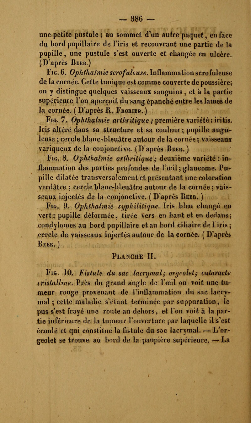 une petite pustule; au sommet d'un autre paquet, en face du bord pupillaire de l'iris et recouvrant une partie de la pupille, une pustule s'est ouverte et changée en ulcère. (D'après Béer.) Fig. 6. Ophthalmie scrofuleuse. Inflammation scrofuleuse de la cornée. Cette tunique est comme couverte de poussière; on y distingue quelques vaisseaux sanguins , et à la partie supérieure l'on aperçoit du sang épanché entre les lames de la cornée. ( D'après R. Froriep. ) Fig. 7. Ophthalmie arthritique ; première variété : iritis. Iris altéré dans sa structure et sa couleur; pupille angu- leuse ; cercle blanc-bleuâtre autour de la cornée ; vaisseaux variqueux de la conjonctive. (D'après Béer.) Fig. 8. Ophthalmie arthritique ; deuxième variété : in- flammation des parties profondes de l'œil ; glaucome. Pu- pille dilatée transversalement et présentant une coloration verdâtre ; cercle blanc-bleuâtre autour de la cornée; vais- seaux injectés de la conjonctive. ( D'après Béer. ) Fig. 9- Ophthalmie syphilitique. Iris bleu changé en vert; pupille déformée, tirée vers en haut et en dedans; condylomes au bord pupillaire et au bord ciliaire de l'iris; cercle de vaisseaux injectés autour de la cornée. ( D'après. Béer. ) Planche II. Fig, 10. Fistule du sac lacrymal; orgcolet; cataracte cristalline. Près du grand angle de l'œil on voit une tu- meur rouge provenant de l'inflammation du sac lacry- mal ; cette maladie s'étant terminée par suppuration, le pus s'est frayé une route au dehors, et Ton voit à la par- tie inférieure de la tumeur l'ouverture par laquelle il s'est écoulé et qui constitue la fistule du sac lacrymal. — L'or- geolet se trouve au bord de la paupière supérieure. — La