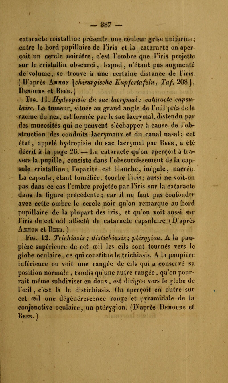 cataracte cristalline présente une couleur grise uniforme, entre le bord pupillaire de l'iris et la cataracte on aper çoit un cercle noirâtre, c'est l'ombre que l'iris projette sur le cristallin obscurci, lequel, n'étant pas augmente de volume, se trouve à une certaine distance de l'iris, (D'après Ammon [chirurgische Kupferlafeln, Taf. 208], Demours et Béer. ) Fie. II. Hydropisie du sac lacrymal; cataracte capsu- laire. La tumeur, située au grand angle de l'œil près de la racine du nez, est formée par le sac lacrymal, distendu par des mucosités qui ne peuvent s'écbapper à cause de l'ob- struction des conduits lacrymaux et du canal nasal: cet état, appelé bydropisie du sac lacrymal par Béer, a été décrit à la page 26. — La cataracte qu'on aperçoit à tra- vers la pupille, consiste dans l'obscurcissement de la cap- sule cristalline; l'opacité est blanche, inégale, nacrée. La capsule, étant tuméfiée, touche l'iris; aussi ne voit-on pas dans ce cas l'ombre projetée par l'iris sur la cataracte dans la figure précédente ; car il ne faut pas confondre avec cette ombre le cercle noir qu'on remarque au bord pupillaire de la plupart des iris, et qu'on voit aussi sur l'iris de cet œil affecté de cataracte capsulaire. ( D'après Ammon et Béer. ) Fig. 12. Trichiasis ; distichiasis ; pte'ryyion. A la pau- pière supérieure de cet œil les cils sont tournés vers le globe oculaire, ce qui constitue le trichiasis. A la paupière inférieure on voit une rangée de cils qui a conservé sa position normale , tandis qu'une autre rangée . qu'on pour- rait même subdiviser en deux , est dirigée vers le globe de l'œil, c'est là le distichiasis. On aperçoit en outre sur cet œil une dégénérescence rouge et pyramidale de la conjonctive oculaire, tin ptérygion. (D'après Demoers et Béer. )