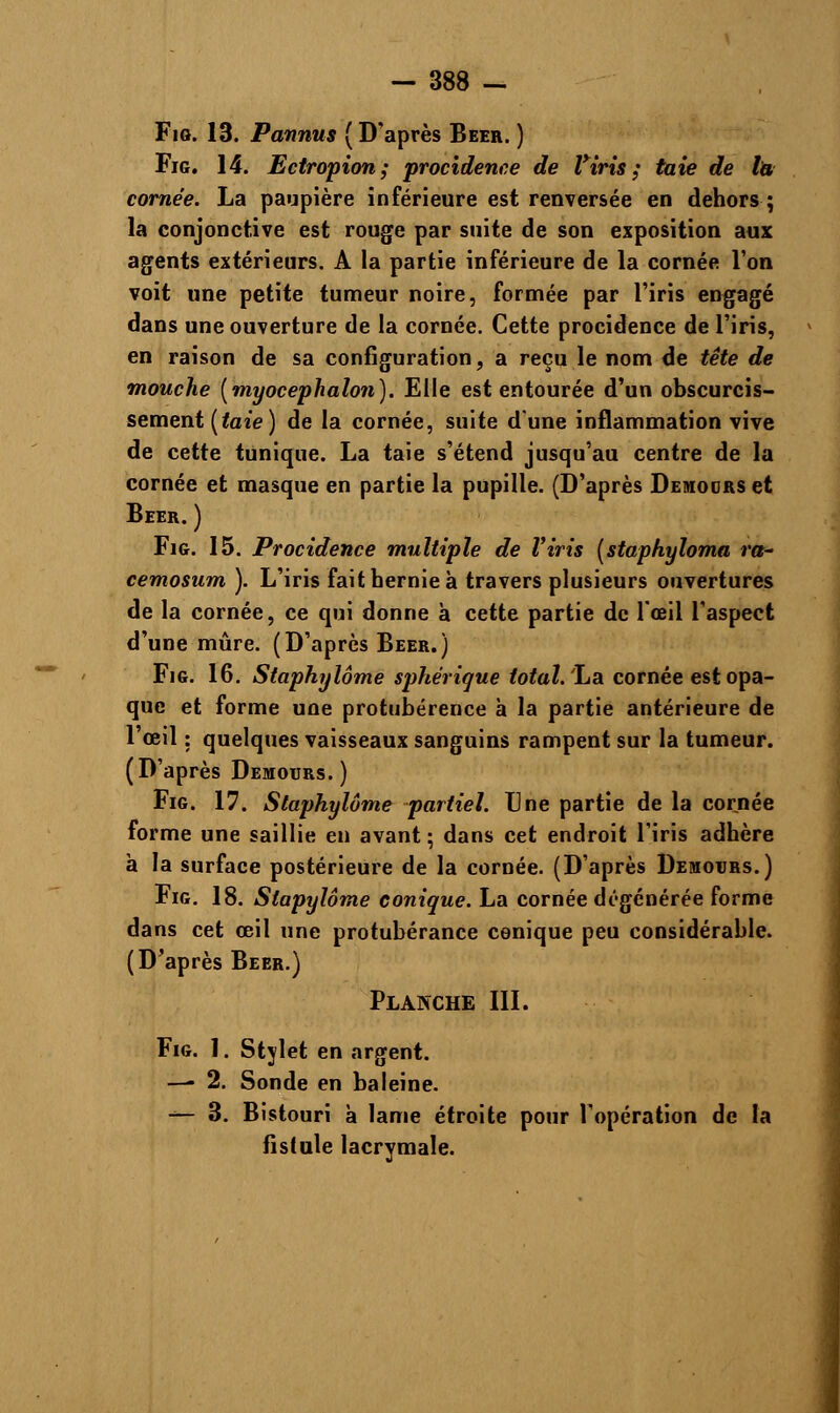 Fio. 13. Pannus ( D'après Béer. ) Fig. 14. Ectropion; procidence de Viris ; taie de la cornée. La paupière inférieure est renversée en dehors ; la conjonctive est rouge par suite de son exposition aux agents extérieurs. A la partie inférieure de la cornée l'on voit une petite tumeur noire, formée par l'iris engagé dans une ouverture de la cornée. Cette procidence de l'iris, en raison de sa configuration, a reçu le nom de tête de mouche (myocephalon). Elle est entourée d'un obscurcis- sement {taie) de la cornée, suite d'une inflammation vive de cette tunique. La taie s'étend jusqu'au centre de la cornée et masque en partie la pupille. (D'après Demours et Béer. ) Fig. 15. Procidence multiple de Viris (staphyloma ra- cemosum ). L'iris fait hernie à travers plusieurs ouvertures de la cornée, ce qui donne à cette partie de l'œil l'aspect d'une mûre. (D'après Béer.) Fig. 16. Staphylôme sphérigue total.'La cornée est opa- que et forme une protubérence à la partie antérieure de l'œil : quelques vaisseaux sanguins rampent sur la tumeur. (D'après Demours.) Fig. 17. Staphylôme partiel. Une partie de la cornée forme une saillie en avant ; dans cet endroit l'iris adhère à la surface postérieure de la cornée. (D'après Demours.) Fig. 18. Siapylôme conique. La cornée dégénérée forme dans cet œil une protubérance conique peu considérable. (D'après Béer.) Planche III. Fig. 1. Stylet en argent. —- 2. Sonde en baleine. -^- 3. Bistouri à lame étroite pour l'opération de la fistule lacrymale.