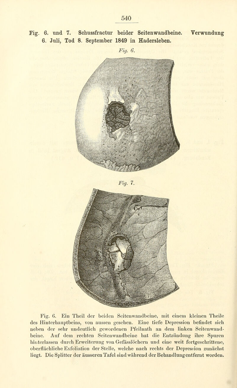 Fig. 6. und 7. Schussfractur beider Seitenwandbeine. Verwundung 6. Juli, Tod 8. September 1849 in Hadersleben. Fig. 6. Fig. 7. Fig. 6. Ein Theil der beiden Seitenwandbeine, mit einem kleinen Theile des Hinterhauptbeins, von aussen gesehen. Eine tiefe Depression befindet sich neben der sehr undeutlich gewordenen Pfeilnath an dem linken Seitenwand- beine. Auf dem rechten Seitenwandbeine hat die Entzündung ihre Spuren hinterlassen durch Erweiterung von Gefässlöchern und eine weit fortgeschrittene, oberflächliche Exfoliation der Stelle, welche nach rechts der Depression zunächst liegt. Die Splitter der äusseren Tafel sind während der Behandlung entfernt worden.