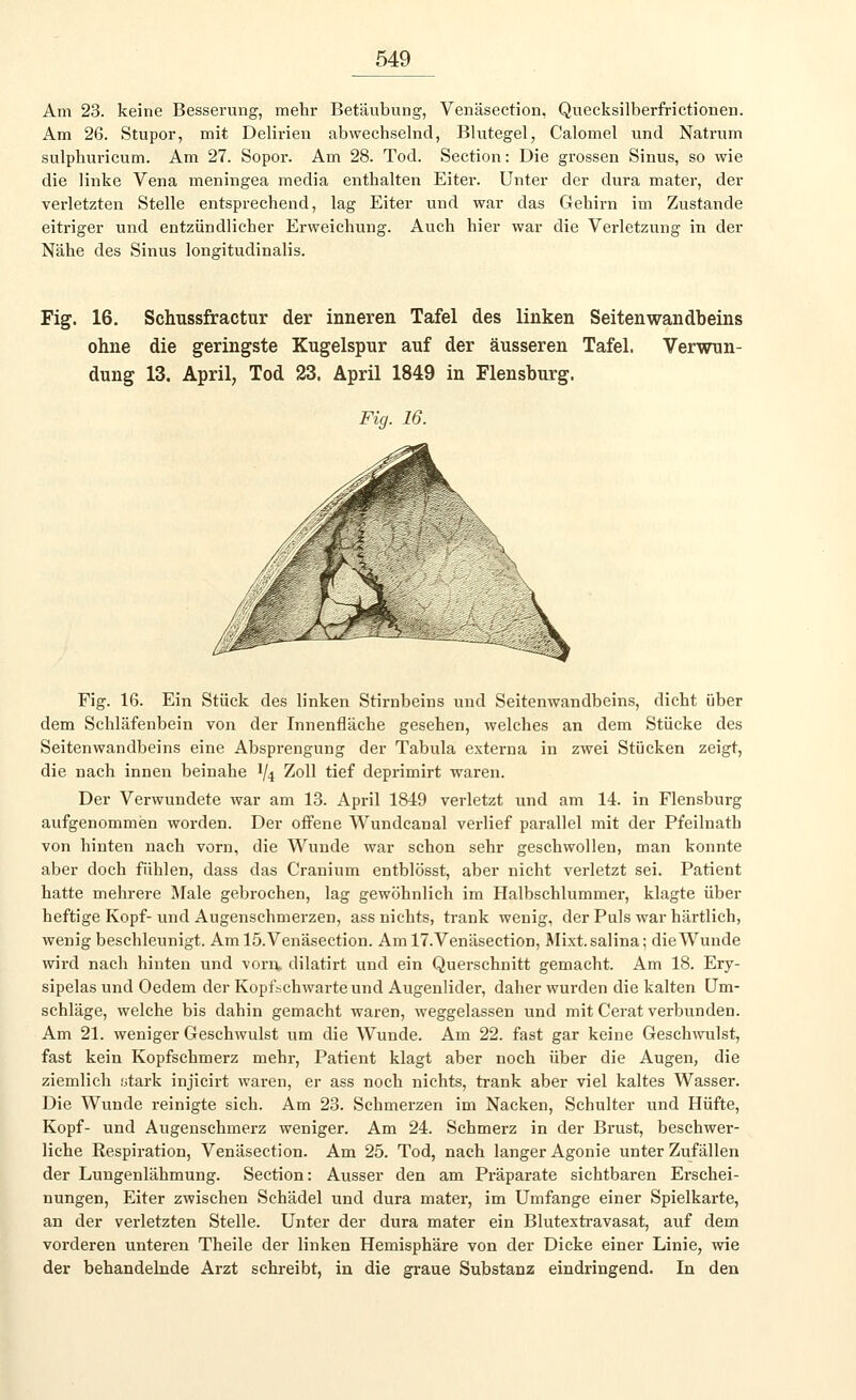 Am 23. keine Besserung, mehr Betäubung, Venäsection, Quecksilberfrictionen. Am 26. Stupor, mit Delirien abwechselnd, Blutegel, Calomel und Natrum sulpburicum. Am 27. Sopor. Am 28. Tod. Section: Die grossen Sinus, so wie die linke Vena meningea media enthalten Eiter. Unter der dura mater, der verletzten Stelle entsprechend, lag Eiter und war das Gehirn im Zustande eitriger und entzündlicher Erweichung. Auch hier war die Verletzung in der Nähe des Sinus longitudinalis. Fig. 16. Schussfractur der inneren Tafel des linken Seitenwandbeins ohne die geringste Kugelspur auf der äusseren Tafel. Verwun- dung 13. April, Tod 23. April 1849 in Flensburg. Fig. 16. Fig. 16. Ein Stück des linken Stirnbeins und Seitenwandbeins, dicht über dem Schläfenbein von der Innenfläche gesehen, welches an dem Stücke des Seitenwandbeins eine Absprengung der Tabula externa in zwei Stücken zeigt, die nach innen beinahe 1/4 Zoll tief deprimirt waren. Der Verwundete war am 13. April 1849 verletzt und am 14. in Flensburg aufgenommen worden. Der offene Wundcanal verlief parallel mit der Pfeilnath von hinten nach vorn, die Wunde war schon sehr geschwollen, man konnte aber doch fühlen, dass das Cranium entblösst, aber nicht verletzt sei. Patient hatte mehrere Male gebrochen, lag gewöhnlich im Halbschlummer, klagte über heftige Kopf- und Augenschmerzen, ass nichts, trank wenig, der Puls war härtlich, wenig beschleunigt. Am 15.Venäsection. Am 17.Venäsection, Mixt.salina; dieWunde wird nach hinten und vorn» dilatirt und ein Querschnitt gemacht. Am 18. Ery- sipels und Oedem der Kopfschwarteund Augenlider, daher wurden die kalten Um- schläge, welche bis dahin gemacht waren, weggelassen und mit Cerat verbunden. Am 21. weniger Geschwulst um die Wunde. Am 22. fast gar keine Geschwulst, fast kein Kopfschmerz mehr, Patient klagt aber noch über die Augen, die ziemlich stark injicirt waren, er ass noch nichts, trank aber viel kaltes Wasser. Die Wunde reinigte sich. Am 23. Schmerzen im Nacken, Schulter und Hüfte, Kopf- und Augenschmerz weniger. Am 24. Schmerz in der Brust, beschwer- liche Eespiration, Venäsection. Am 25. Tod, nach langer Agonie unter Zufällen der Lungenlähmung. Section: Ausser den am Präparate sichtbaren Erschei- nungen, Eiter zwischen Schädel und dura mater, im Umfange einer Spielkarte, an der verletzten Stelle. Unter der dura mater ein Blutextravasat, auf dem vorderen unteren Theile der linken Hemisphäre von der Dicke einer Linie, wie der behandelnde Arzt schreibt, in die graue Substanz eindringend. In den