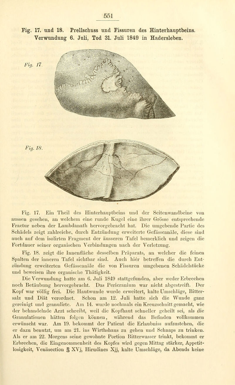 Fig. 17. und 18. Prellschuss und Fissuren des Hinterhauptbeins. Verwundung 6. Juli, Tod 31. Juli 1849 in Hadersleben. Fig. 17. & Fig. 18. Fig. 17. Ein Theil des Hinterhauptbeins und der Seitenwandbeine von aussen gesehen, an welchem eine runde Kugel eine ihrer Grösse entsprechende Fractur neben der Lambdanath hervorgebracht hat. Die umgebende Partie des Schädels zeigt zahlreiche, durch Entzündung erweiterte Gefässcanäle, diese sind auch auf dem isolirten Fragment der äusseren Tafel bemerklich und zeigen die Fortdauer seiner organischen Verbindungen nach der Verletzung. Fig. 18. zeigt die Innenfläche desselben Präparats, an welcher die feinen Spalten der inneren Tafel sichtbar sind. Auch hier betreffen die durch Ent- zündung erweiterten Gefässcanäle die von Fissuren umgebenen Schädelstücke und beweisen ihre organische Thätigkeit. Die Verwundung hatte am 6. Juli 1849 stattgefunden, aber weder Erbrechen noch Betäubung hervorgebracht. Das Pericranium war nicht abgestreift. Der Kopf war völlig frei. Die Hautwunde wurde erweitert, kalte Umschläge, Bitter- salz und Diät verordnet. Schon am 12. Juli hatte sich die Wunde ganz gereinigt und granulirte. Am 14. wurde nochmals ein Kreuzschnitt gemacht, wie der behandelnde Arzt schreibt, weil die Kopfhaut schneller geheilt sei, als die Granulationen hätten folgen können, während das Befinden vollkommen erwünscht war. Am 19. bekommt der Patient die Erlaubniss aufzustehen, die er dazu benutzt, um am 21. ins Wirthshaus zu gehen und Schnaps zu trinken. Als er am 22. Morgens seine gewohnte Portion Bitterwasser trinkt, bekommt er Erbrechen, die Eingenommenheit des Kopfes wii-d gegen Mittag stärker, Appetit- losigkeit, Venäsection § XVj, Hirudines Xjj, kalte Umschläge, da Abends keine