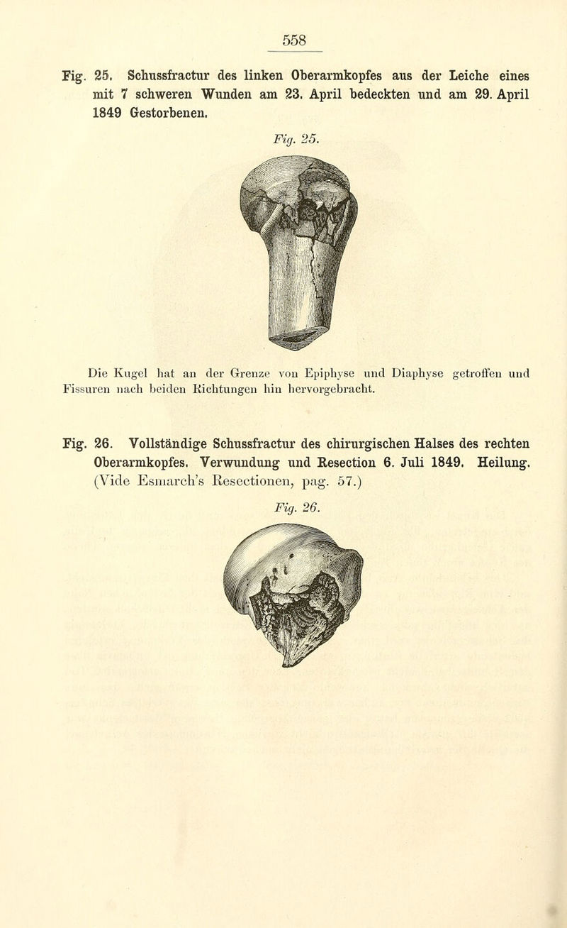 Fig. 25. Schussfractur des linken Oberarmkopfes aus der Leiche eines mit 7 schweren Wunden am 23. April bedeckten und am 29. April 1849 Gestorbenen. Fig. 25. Die Kugel hat an der Grenze von Epiphyse und Diaphyse getroffen und Fissuren nach beiden Richtungen hin hervorgebracht. Fig. 26. Vollständige Schussfractur des chirurgischen Halses des rechten Oberarmkopfes. Verwundung und Resection 6. Juli 1849. Heilung. (Vide Esrnarch's Resectionen, pag. 57.) Fig. 26.