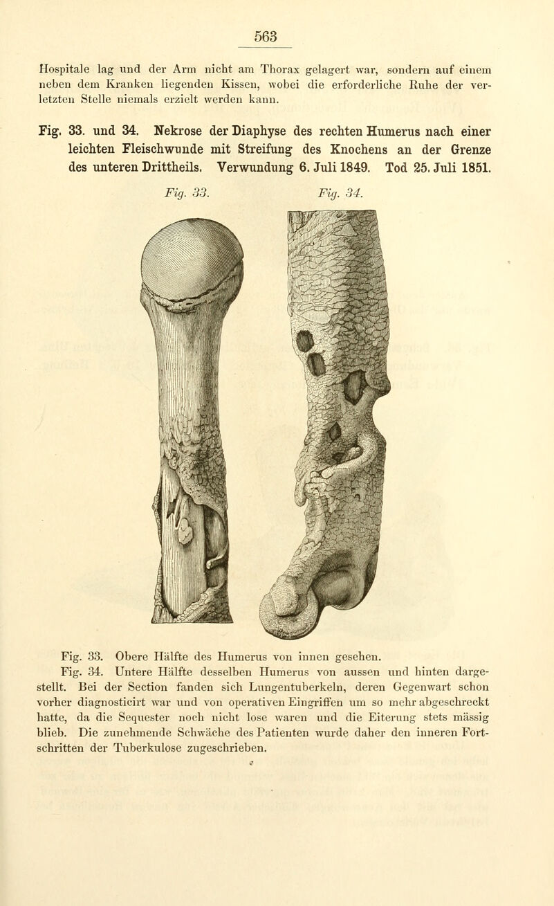 Hospitale lag und der Arm nicht am Thorax gelagert war, sondern auf einem neben dem Kranken liegenden Kissen, wobei die erforderliche Ruhe der ver- letzten Stelle niemals erzielt werden kann. Fig. 33. und 34. Nekrose der Diaphyse des rechten Humerus nach einer leichten Fleischwunde mit Streifung des Knochens an der Grenze des unteren Drittheils. Verwundung 6. Juli 1849. Tod 25. Juli 1851. Fig. 33. Fig. 34. Fig. 33. Obere Hälfte des Humerus von innen gesehen. Fig. 34. Untere Hälfte desselben Humerus von aussen und hinten darge- stellt. Bei der Section fanden sich Lungentuberkeln, deren Gegenwart schon vorher diagnosticirt war und von operativen Eingriffen um so mehr abgeschreckt hatte, da die Sequester noch nicht lose waren und die Eiterung stets massig blieb. Die zunehmende Schwäche des Patienten wurde daher den inneren Fort- schritten der Tuberkulose zugeschrieben.