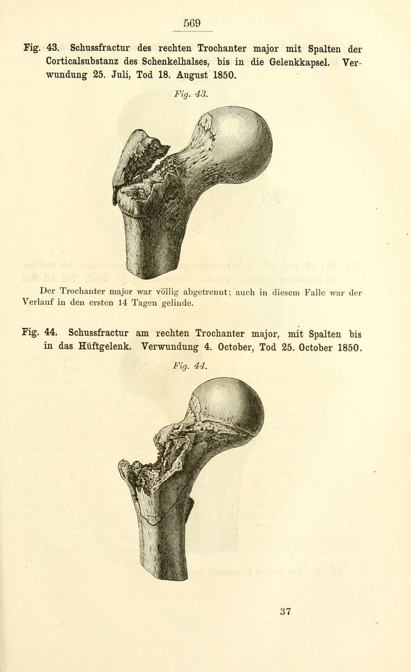 Fig. 43. Schussfractur des rechten Trochanter major mit Spalten der Corticalsubstanz des Schenkelhalses, bis in die Gelenkkapsel. Ver- wundung 25. Juli, Tod 18. August 1850. Fig. 43. Der Trochanter major war völlig abgetrennt; auch in diesem Falle war der Verlauf in den ersten 14 Tagen gelinde. Fig. 44. Schussfractur am rechten Trochanter major, mit Spalten bis in das Hüftgelenk. Verwundung 4. October, Tod 25. October 1850. Fig. 44. 37