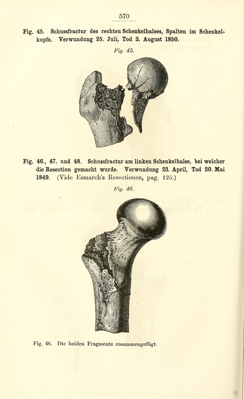 Fig. 45. Schussfractur des rechten Schenkelhalses, Spalten im Schenkel- kopfe, Verwundung 25. Juli, Tod 3. August 1850. Fig. 45. Fig, 46., 47. und 48. Schussfractur am linken Schenkelhalse, bei welcher die Resection gemacht wurde. Verwundung 23. April, Tod 20. Mai 1849. (Vide Esmarch's Resectionen, pag. 125.) Fig. 46. Fig. 46. Die beiden Fragmente zusammengefügt.