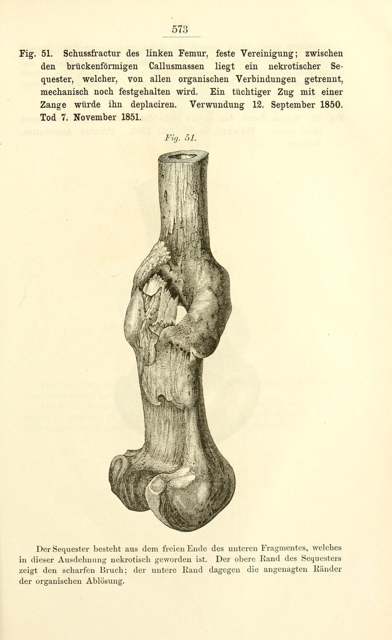 Fig. 51. Schussfractur des linken Femur, feste Vereinigung; zwischen den brtickenförmigen Callusmassen liegt ein nekrotischer Se- quester, welcher, von allen organischen Verbindungen getrennt, mechanisch noch festgehalten wird. Ein tüchtiger Zug mit einer Zange würde ihn deplaciren. Verwundung 12. September 1850. Tod 7. November 1851. Fig. 51. Der Sequester besteht aus dem freien Ende des unteren Fragmentes, welches in dieser Ausdehnung nekrotisch geworden ist. Der obere Eand des Sequesters zeigt den scharfen Bruch; der untere Rand dagegen die angenagten Ränder der organischen Ablösung.