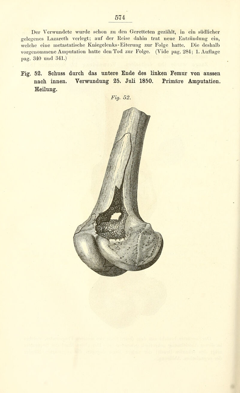 Der Vei-wundete wurde schon zu den Geretteten gezählt, in ein südlicher gelegenes Lazareth verlegt; auf der Reise dahin trat neue Entzündung ein, welche eine metastatische Kniegelenks-Eiterung zur Folge hatte. Die deshalb vorgenommene Amputation hatte den Tod zur Folge. (Vide pag. 284; 1. Auflage pag. 340 und 341.) Fig. 52. Schuss durch das untere Ende des linken Femur von aussen nach innen. Verwundung 25. Juli 1850. Primäre Amputation. Heilung. Fig. 52.