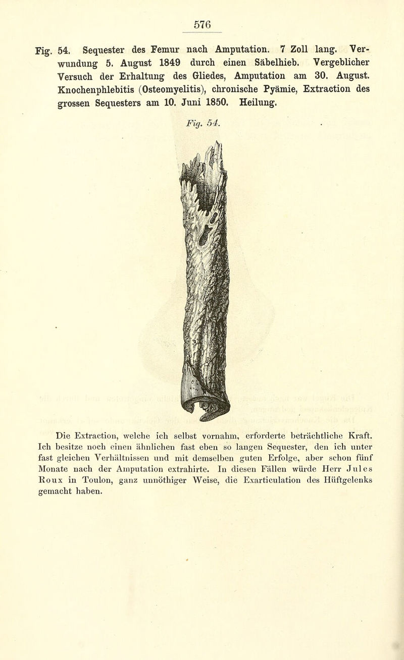 Fig. 54. Sequester des Feimir nach Amputation. 7 Zoll lang. Ver- wundung 5. August 1849 durch einen Säbelhieb. Vergeblicher Versuch der Erhaltung des Gliedes, Amputation am 30. August. Knochenphlebitis (Osteomyelitis), chronische Pyämie, Extraction des grossen Sequesters am 10. Juni 1850. Heilung. Fig. 54. Die Extraction, welche ich selbst vornahm, erforderte beträchtliche Kraft. Ich besitze noch einen ähnlichen fast eben so langen Sequester, den ich unter fast gleichen Verhältnissen und mit demselben guten Erfolge, aber schon fünf Monate nach der Amputation extrahirte. In diesen Fällen würde Herr Jules Eoux in Toulon, ganz unnöthiger Weise, die Exarticulation des Hüftgelenks gemacht haben.