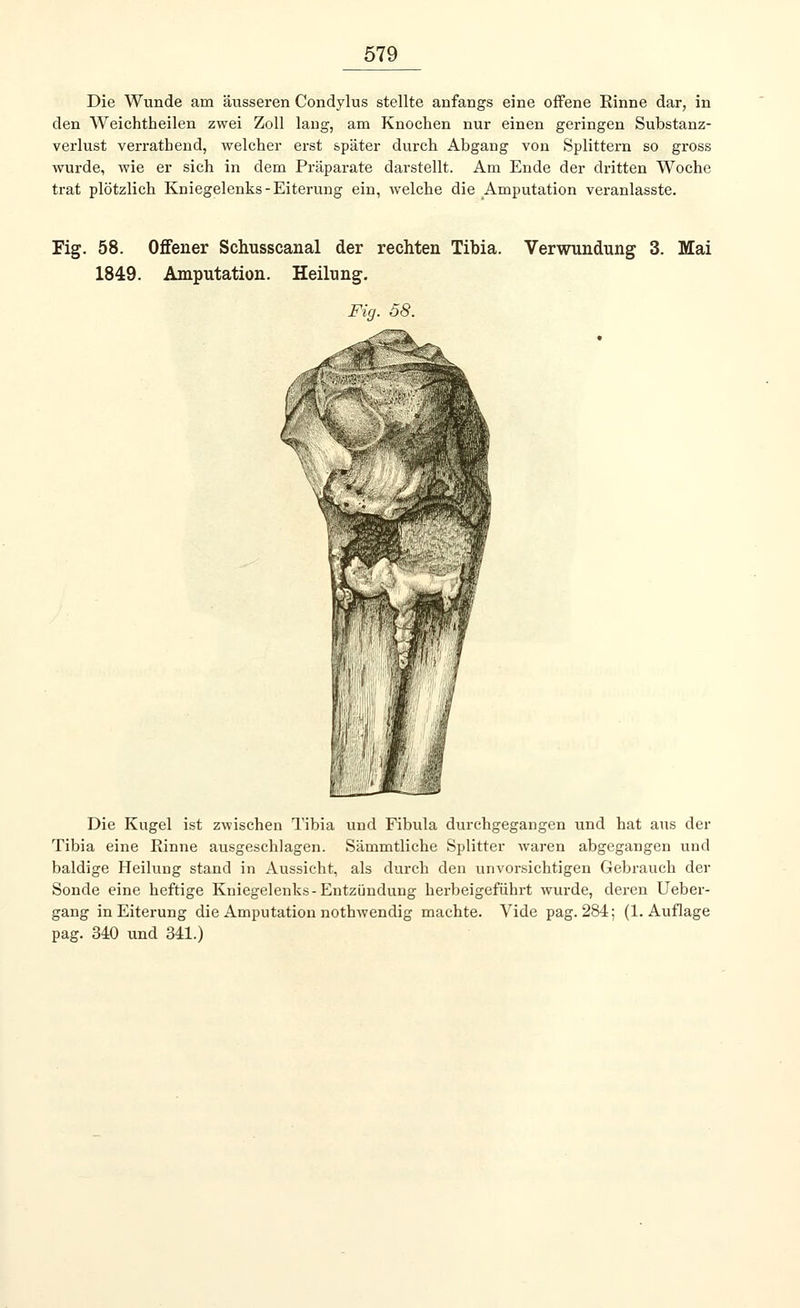 Die Wunde am äusseren Condylus stellte anfangs eine offene Rinne dar, in den Weichtheilen zwei Zoll lang, am Knochen nur einen geringen Substanz- verlust verrathend, welcher erst später durch Abgang von Splittern so gross wurde, wie er sich in dem Präparate darstellt. Am Ende der dritten Woche trat plötzlich Kniegelenks-Eiterung ein, welche die Amputation veranlasste. Fig. 58. Offener Schusscanal der rechten Tibia. 1849. Amputation. Heilung1. Fig. 58. Verwundung 3. Mai Die Kugel ist zwischen Tibia und Fibula durchgegangen und hat aus der Tibia eine Rinne ausgeschlagen. Sämmtliche Splitter waren abgegangen und baldige Heilung stand in Aussicht, als durch den unvorsichtigen Gebrauch der Sonde eine heftige Kniegelenks-Entzündung herbeigeführt wurde, deren Ueber- gang in Eiterung die Amputation nothwendig machte. Vide pag. 284; (1. Auflage pag. 340 und 341.)