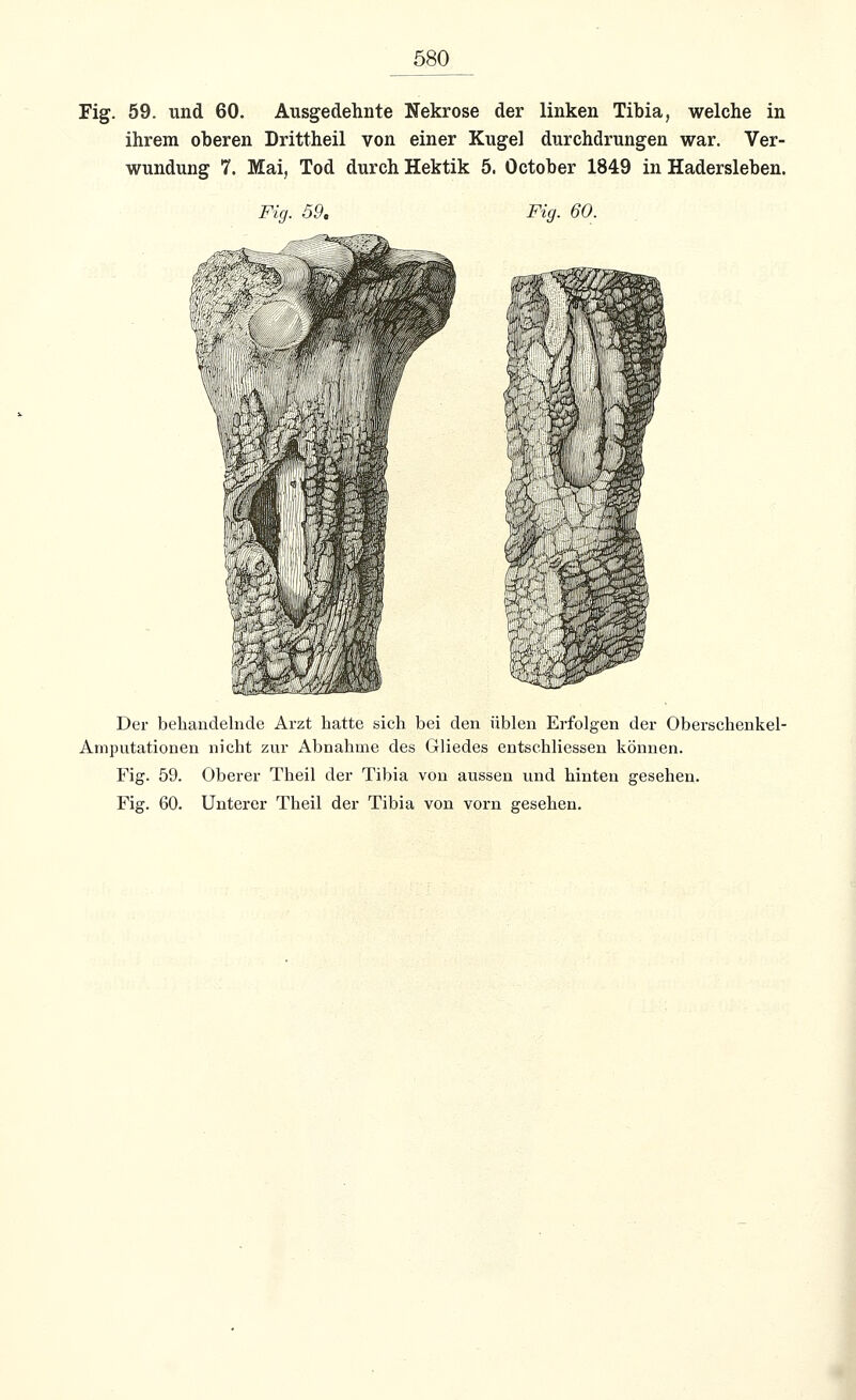 Fig. 59. und 60. Ausgedehnte Nekrose der linken Tibia, welche in ihrem oberen Drittheil von einer Kugel durchdrungen war. Ver- wundung 7. Mai, Tod durch Hektik 5. October 1849 in Hadersleben. Fig. 59. Fig. 60. Der behandelnde Arzt hatte sich bei den üblen Erfolgen der Obersehenkel- Amputationen nicht zur Abnahme des Gliedes entschliessen können. Fig. 59. Oberer Theil der Tibia von aussen und hinten gesehen. Fig. 60. Unterer Theil der Tibia von vorn gesehen.