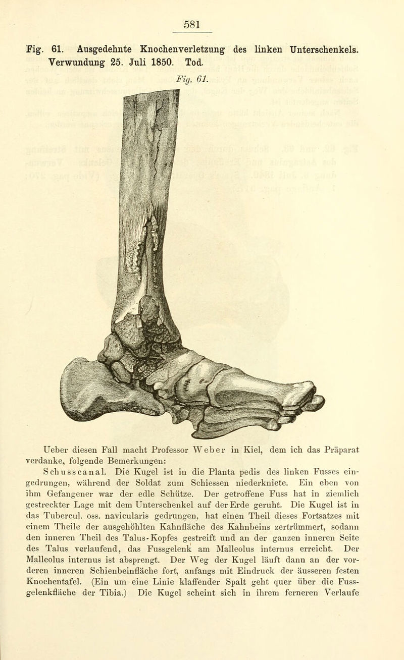 Fig. 61. Ausgedehnte Knochenverletzung des linken Unterschenkels. Verwundung 25. Juli 1850. Tod. Fig. 61. Ueber diesen Fall macht Professor Weber in Kiel, dem ich das Präparat verdanke, folgende Bemerkungen: Schusscanal. Die Kugel ist in die Planta pedis des linken Fusses ein- gedrungen, während der Soldat zum Schiessen niederkniete. Ein eben von ihm Gefangener war der edle Schütze. Der getroffene Fuss hat in ziemlich gestreckter Lage mit dem Unterschenkel auf der Erde geruht. Die Kugel ist in das Tubercul. oss. navicularis gedrungen, hat einen Theil dieses Fortsatzes mit einem Theile der ausgehöhlten Kahnfläche des Kahnbeins zertrümmert, sodann den inneren Theil des Talus-Kopfes gestreift und an der ganzen inneren Seite des Talus verlaufend, das Fussgelenk am Malleolus internus erreicht. Der Malleolus internus ist absprengt. Der Weg der Kugel läuft dann an der vor- deren inneren Schienbeinfläche fort, anfangs mit Eindruck der äusseren festen Knochentafel. (Ein um eine Linie klaffender Spalt geht quer über die Fuss- gelenkfläche der Tibia.) Die Kugel scheint sich in ihrem ferneren Verlaufe