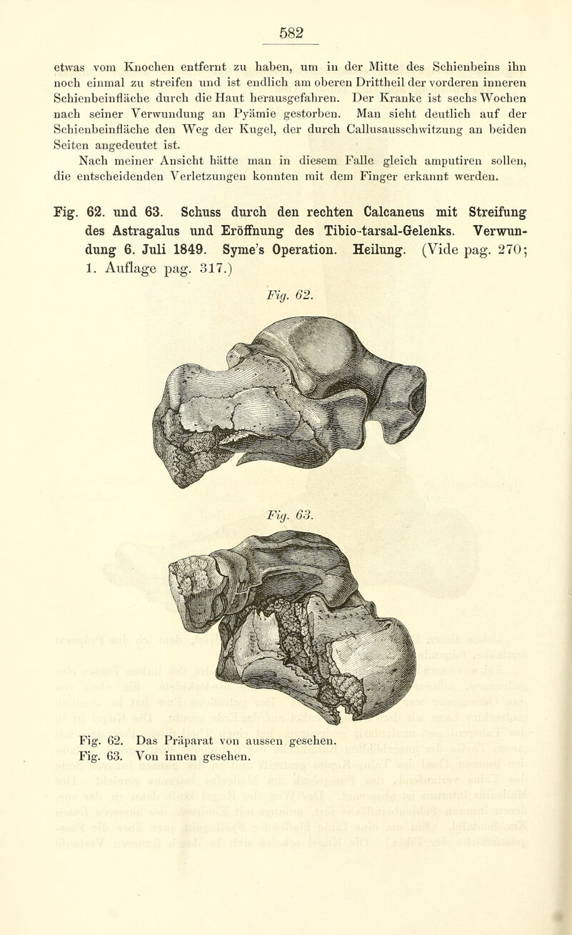 etwas vom Knochen entfernt zu haben, um in der Mitte des Schienbeins ihn noch einmal zu streifen und ist endlich am oberen Drittheil der vorderen inneren Schienbeinfläche durch die Haut herausgefahren. Der Kranke ist sechs Wochen nach seiner Verwundung an Pyämie gestorben. Man sieht deutlich auf der Schienbeinfläche den Weg der Kugel, der durch Callusausschwitzung an beiden Seiten angedeutet ist. Nach meiner Ansicht hätte man in diesem Falle gleich amputiren sollen, die entscheidenden Verletzungen konnten mit dem Finger erkannt werden. Fig. 62. und 63. Schuss durch den rechten Calcaneus mit Streifung des Astragalus und Eröffnung des Tibio-tarsal-Gelenks. Verwun- dung 6. Juli 1849. Syme's Operation. Heilung. (Viele pag. 270; 1. Auflage pag. 317.) Fig. 62. Fig. 63. Fig. 62. Das Präparat von aussen gesehen. Fig. 63. Von innen gesehen.