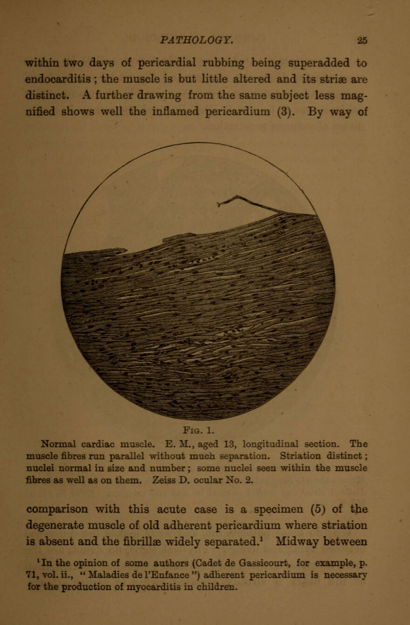 within two days of pericardial rubbing being superadded to endocarditis; the muscle is but little altered and its striae are distinct. A further drawing from the same subject less mag- nified shows well the inflamed pericardium (3). By way of Fig. 1. Normal cardiac niuscle. E. 1£, aged 13, longitudinal section. The muscle fibres run parallel without much separation. Striation distinct; nuclei normal in size and number; some nuclei seen within the muscle fibres as well as on them. Zeiss D. ocular No. 2. comparison with this acute case is a specimen (5) of the degenerate muscle of old adherent pericardium where striation is absent and the fibrillae widely separated.1 Midway between 1 In the opinion of some authors (Cadet de Gassicourt, for example, p. 71, vol. ii.,  Maladies del'Enfance) adherent pericardium is necessary for the production of myocarditis in children.