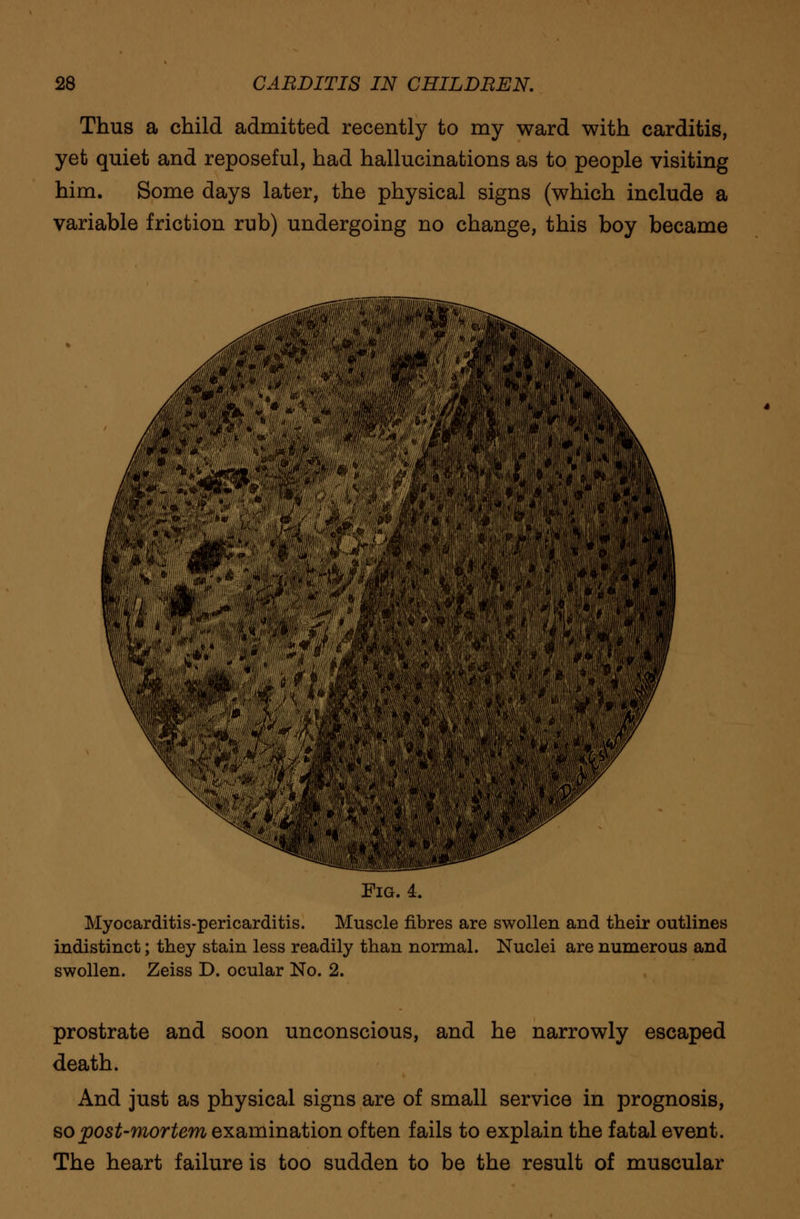 Thus a child admitted recently to my ward with carditis, yet quiet and reposeful, had hallucinations as to people visiting him. Some days later, the physical signs (which include a variable friction rub) undergoing no change, this boy became Fig. 4. Myocarditis-pericarditis. Muscle fibres are swollen and their outlines indistinct; they stain less readily than normal. Nuclei are numerous and swollen. Zeiss D. ocular No. 2. prostrate and soon unconscious, and he narrowly escaped death. And just as physical signs are of small service in prognosis, so post-mortem examination often fails to explain the fatal event. The heart failure is too sudden to be the result of muscular