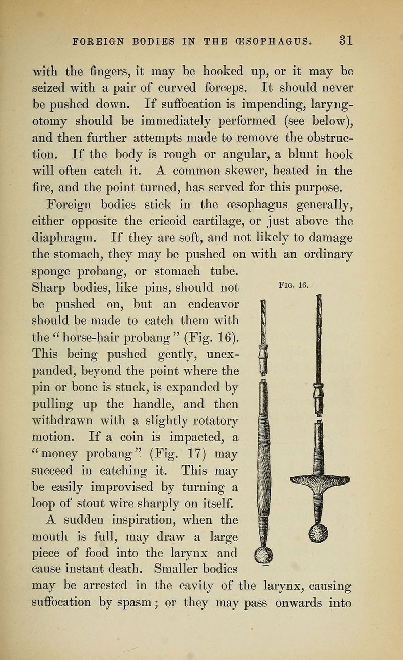 Fig. 16. with the fingers^ it may be hooked up, or it may be seized with a pair of curved forceps. It should never be pushed down. If suffocation is impending, laryng- otomy should be immediately performed (see below), and then further attempts made to remove the obstruc- tion. If the body is rough or angular, a blunt hook will often catch it. A common skewer, heated in the fire, and the point turned, has served for this purpose. Foreign bodies stick in the oesophagus generally, either opposite the cricoid cartilage, or just above the diaphragm. If they are soft, and not likely to damage the stomach, they may be pushed on with an ordinary sponge probang, or stomach tube. Sharp bodies, like pins, should not be pushed on, but an endeavor should be made to catch them with the horse-hair probang (Fig. 16). This being pushed gently, unex- panded, beyond the point where the pin or bone is stuck, is expanded by pulling up the handle, and then withdrawn with a slightly rotatory motion. If a coin is impacted, a money probang'' (Fig. 17) may succeed in catching it. This may be easily improvised by turning a loop of stout wire sharply on itself. A sudden inspiration, when the mouth is full, may draw a large piece of food into the larynx and cause instant death. Smaller bodies may be arrested in the cavity of the larynx, causing suffocation by spasm; or they may pass onwards into