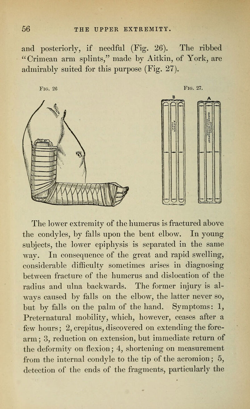 and posteriorly, if needful (Fig. 26). The ribbed Crimean arm splints/' made by Aitkin, of York, are admirably suited for this purpose (Fig. 27). Fig. 26 The lower extremity of the humerus is fractured above the condyles, by falls upon the bent elbow. In young subjects, the lower epiphysis is separated in the same WW. In consequence of the great and rapid swelling, considerable difficulty sometimes arises in diagnosing between fracture of the humerus and dislocation of the radius and ulna backwards. The former injury is al- ways caused by falls on the elbow, the latter never so, but by falls on the palm of the hand. Symptoms: 1, Preternatural mobility, which, however, ceases after a few hours; 2, crepitus, discovered on extending the fore- arm; 3, reduction on extension, but immediate return of the deformity on flexion; 4, shortening on measurement from the internal condyle to the tip of the acromion; 5, detection of the ends of the fragments, particularly the