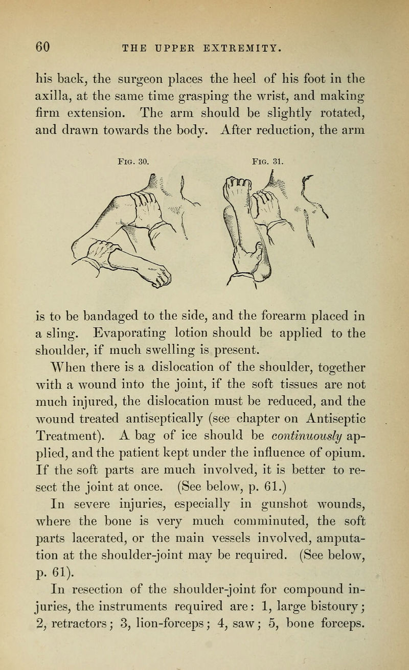 his back, the surgeon places the heel of his foot in the axilla, at the same time grasping the wrist, and making firm extension. The arm should be slightly rotated, and drawn towards the body. After reduction, the arm Fig. 30. Fig. 31. is to be bandaged to the side, and the forearm placed in a sling. Evaporating lotion should be applied to the shoulder, if much swelling is present. When there is a dislocation of the shoulder, together with a wound into the joint, if the soft tissues are not much injured, the dislocation must be reduced, and the wound treated antiseptically (see chapter on Antiseptic Treatment). A bag of ice should be continuously ap- plied, and the patient kept under the influence of opium. If the soft parts are much involved, it is better to re- sect the joint at once. (See below, p. 61.) In severe injuries, especially in gunshot wounds, where the bone is very much comminuted, the soft parts lacerated, or the main vessels involved, amputa- tion at the shoulder-joint may be required. (See below, P- 61). In resection of the shoulder-joint for compound in- juries, the instruments required are: 1, large bistoury; 2, retractors; 3, lion-forceps; 4, saw; 5, bone forceps.