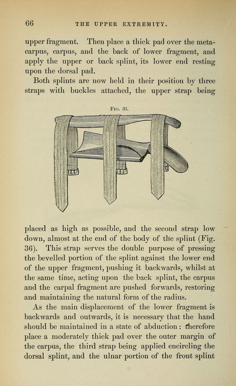 upper fragment. Then place a thick pad over the meta- carpus, carpus, and the back of lower fragment, and apply the upper or back splint, its lower end resting upon the dorsal pad. Both splints are now held in their position by three straps with buckles attached, the upper strap being Fig. 35. placed as high as possible, and the second strap low down, almost at the end of the body of the splint (Fig. 36). This strap serves the double purpose of pressing the bevelled portion of the splint against the lower end of the upper fragment, pushing it backwards, whilst at the same time, acting upon the back splint, the carpus and the carpal fragment are pushed forwards, restoring and maintaining the natural form of the radius. As the main displacement of the lower fragment is backwards and outwards, it is necessary that the hand should be maintained in a state of abduction: llierefore place a moderately thick pad over the outer margin of the carpus, the third strap being applied encircling the dorsal splint, and the ulnar portion of the front splint